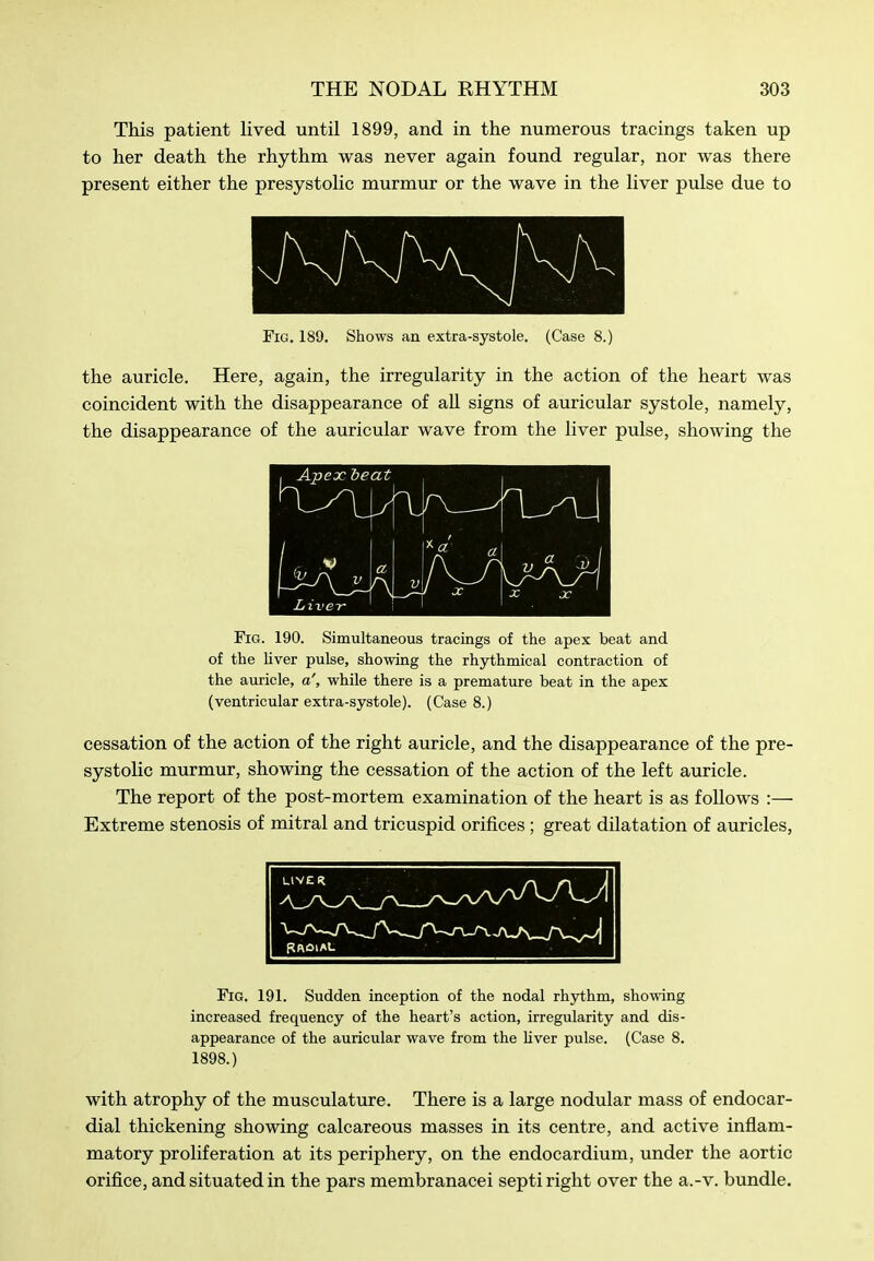 This patient lived until 1899, and in the numerous tracings taken up to her death the rhythm was never again found regular, nor was there present either the presystolic murmur or the wave in the liver pulse due to Fig. 189. Shows an extra-systole. (Case 8.) the auricle. Here, again, the irregularity in the action of the heart was coincident with the disappearance of all signs of auricular systole, namely, the disappearance of the auricular wave from the liver pulse, showing the Apex teat Liver V JO JC Fig. 190. Simultaneous tracings of the apex beat and of the Uver pulse, showing the rhythmical contraction of the auricle, a', while there is a premature beat in the apex (ventricular extra-systole). (Case 8.) cessation of the action of the right auricle, and the disappearance of the pre- systolic murmur, showing the cessation of the action of the left auricle. The report of the post-mortem examination of the heart is as follows :— Extreme stenosis of mitral and tricuspid orifices ; great dilatation of auricles, Fig. 191. Sudden inception of the nodal rhythm, showing increased frequency of the heart's action, irregularity and dis- appearance of the auricular wave from the Hver pulse. (Case 8. 1898.) with atrophy of the musculature. There is a large nodular mass of endocar- dial thickening showing calcareous masses in its centre, and active inflam- matory proliferation at its periphery, on the endocardium, under the aortic orifice, and situated in the pars membranacei septi right over the a.-v. bundle.