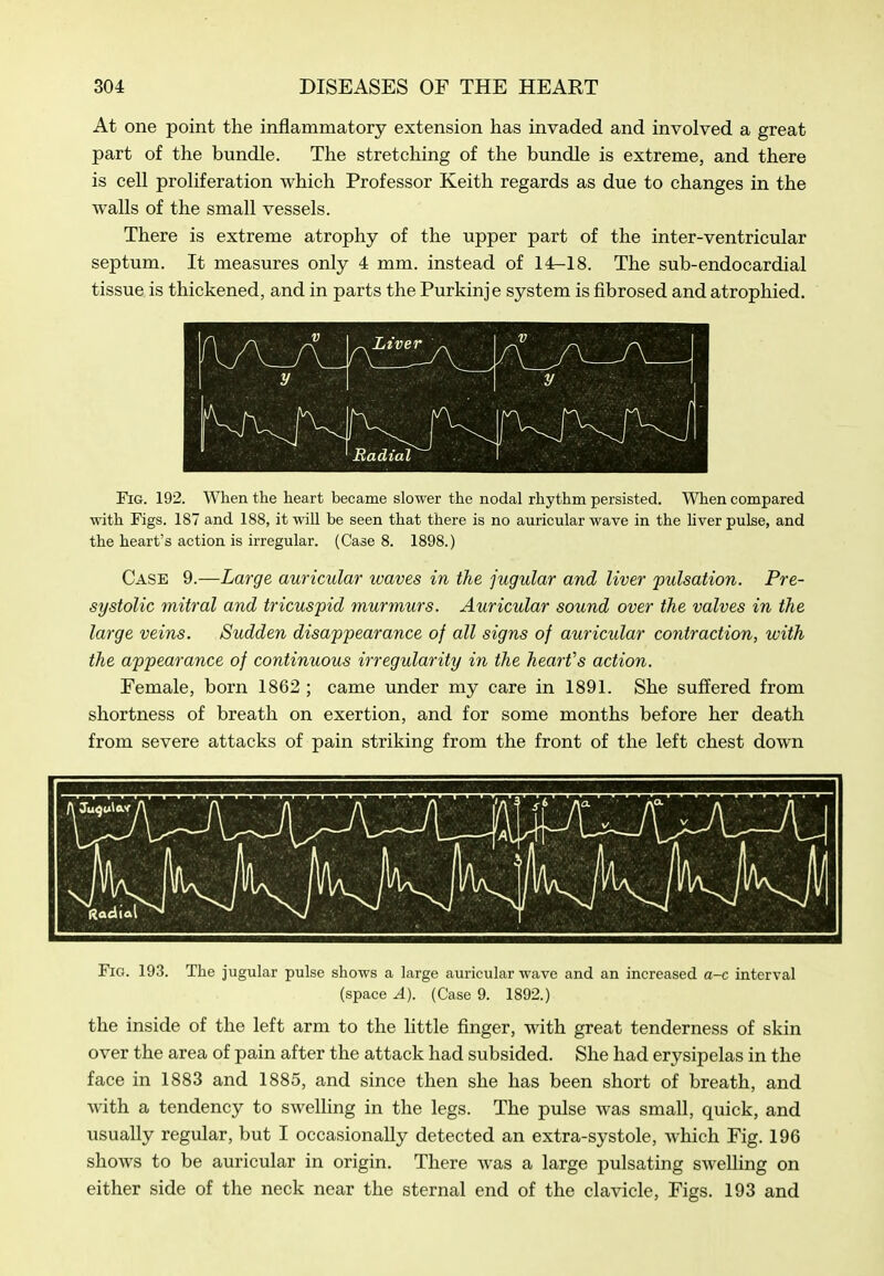 At one point the inflammatory extension has invaded and involved a great part of the bundle. The stretching of the bundle is extreme, and there is cell proliferation which Professor Keith regards as due to changes in the walls of the small vessels. There is extreme atrophy of the upper part of the inter-ventricular septum. It measures only 4 mm. instead of 14^18. The sub-endocardial tissue is thickened, and in parts the Purkinje system is fibrosed and atrophied. V ^ y Fig. 192. When the heart became slower the nodal rhythm persisted. 'When compared with Figs. 187 and 188, it will be seen that there is no auricular wave in the hver pulse, and the heart's action is irregular. (Case 8. 1898.) Case 9.—Large auricular waves in the jugular and liver pulsation. Pre- systolic mitral and tricuspid murmurs. Auricular sound over the valves in the large veins. Sudden disappearance of all signs of auricular contraction, with the appearance of continuous irregularity in the heart's action. Female, born 1862 ; came under my care in 1891. She suffered from shortness of breath on exertion, and for some months before her death from severe attacks of pain striking from the front of the left chest down Fig. 193. The jugular pulse shows a large auricular wave and an increased a-c interval (space A). (Case 9. 1892.) the inside of the left arm to the little finger, with great tenderness of skin over the area of pain after the attack had subsided. She had erysipelas in the face in 1883 and 1885, and since then she has been short of breath, and with a tendency to swelling in the legs. The pulse was small, quick, and usually regular, but I occasionally detected an extra-systole, Avhich Fig. 196 shows to be auricular in origin. There was a large pulsating swelling on either side of the neck near the sternal end of the clavicle, Figs. 193 and