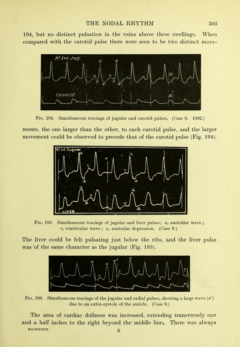 194, but no distinct pulsation in the veins above these swelKngs. When compared with the carotid pulse there were seen to be two distinct move- FiG. 194. Simultaneous tracings of jugular and carotid pulses. (Case 9. 1892.) ments, the one larger than the other, to each carotid pulse, and the larger movement could be observed to precede that of the carotid pulse (Fig. 194). Fig. 195. Simultaneous tracings of jugular and liver pulses; a, auricular wave ; V, ventricular wave ; x, auricular depression. (Case 9.) The liver could be felt pulsating just below the ribs, and the liver pulse was 'of the same character as the jugular (Fig. 195). Fig. 196. Simultaneous tracings of the jugular and radial pulses, showing a large wave [a') due to an extra-systole of the auricle. (Case 9.) The area of cardiac dullness was increased, extending transversely one and a half inches to the right beyond the' middle linej There was always MACKENZIE Y