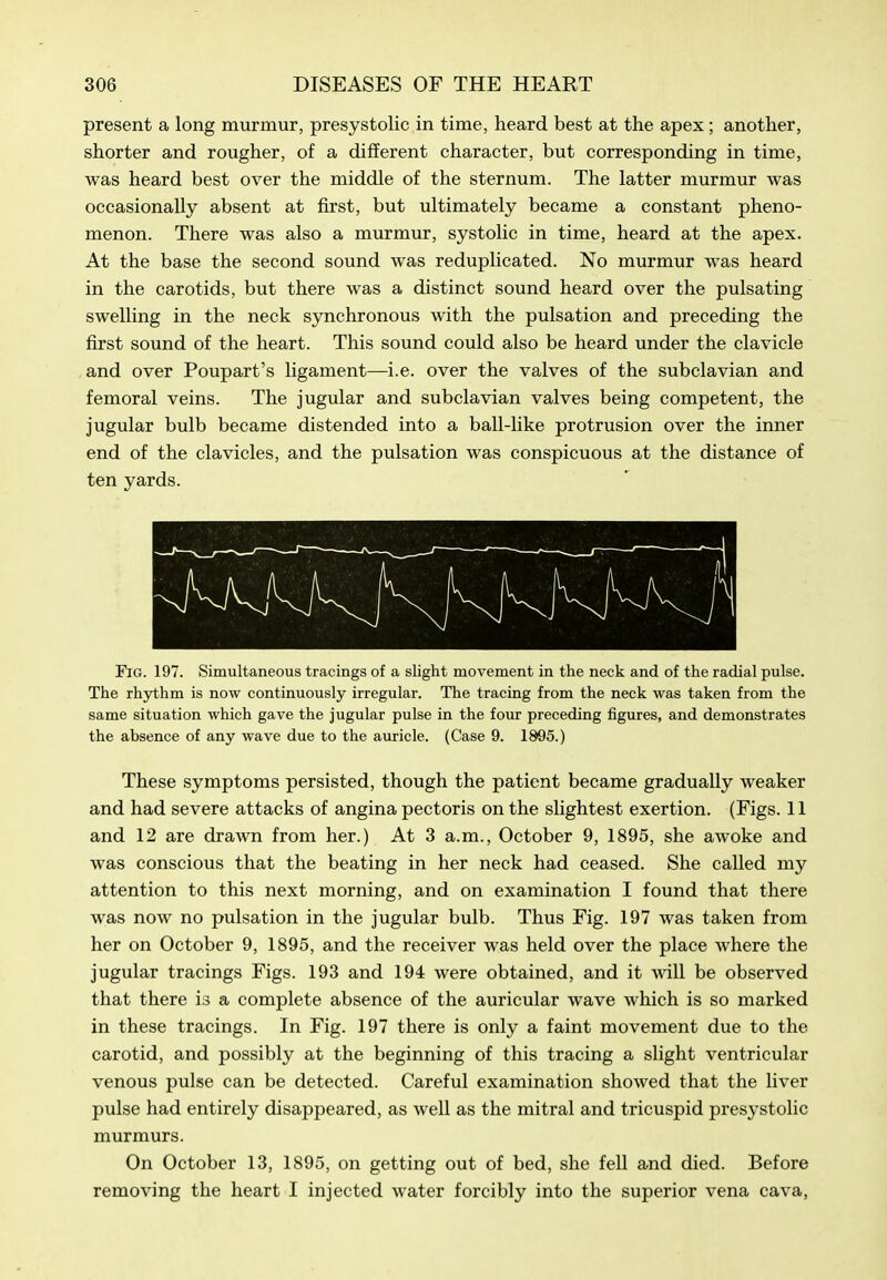 present a long murmur, presystolic in time, heard best at the apex; another, shorter and rougher, of a different character, but corresponding in time, was heard best over the middle of the sternum. The latter murmur was occasionally absent at first, but ultimately became a constant pheno- menon. There was also a murmur, systolic in time, heard at the apex. At the base the second sound was reduplicated. No murmur was heard in the carotids, but there was a distinct sound heard over the pulsating swelling in the neck synchronous with the pulsation and preceding the first sound of the heart. This sound could also be heard under the clavicle and over Poupart's ligament—i.e. over the valves of the subclavian and femoral veins. The jugular and subclavian valves being competent, the jugular bulb became distended into a ball-like protrusion over the inner end of the clavicles, and the pulsation was conspicuous at the distance of ten yards. Fig. 197. Simultaneous tracings of a slight movement in the neck and of the radial pulse. The rhythm is now continuously irregular. The tracing from the neck was taken from the same situation which gave the jugular pulse in the four preceding figures, and demonstrates the absence of any wave due to the auricle. (Case 9. 1805.) These symptoms persisted, though the patient became gradually weaker and had severe attacks of angina pectoris on the slightest exertion. (Figs. 11 and 12 are drawn from her.) At 3 a.m., October 9, 1895, she awoke and was conscious that the beating in her neck had ceased. She called my attention to this next morning, and on examination I found that there was now no pulsation in the jugular bulb. Thus Fig. 197 was taken from her on October 9, 1895, and the receiver was held over the place where the jugular tracings Figs. 193 and 194 were obtained, and it will be observed that there is a complete absence of the auricular wave which is so marked in these tracings. In Fig. 197 there is only a faint movement due to the carotid, and possibly at the beginning of this tracing a slight ventricular venous pulse can be detected. Careful examination showed that the liver pulse had entirely disappeared, as well as the mitral and tricuspid presystolic murmurs. On October 13, 1895, on getting out of bed, she fell and died. Before removing the heart I injected water forcibly into the superior vena cava,