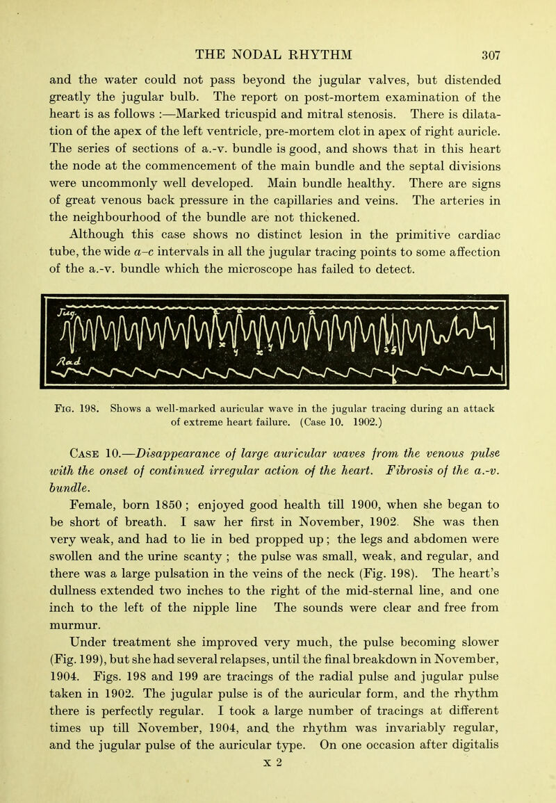and the water could not pass beyond the jugular valves, but distended greatly the jugular bulb. The report on post-mortem examination of the heart is as follows :—Marked tricuspid and mitral stenosis. There is dilata- tion of the apex of the left ventricle, pre-mortem clot in apex of right auricle. The series of sections of a.-v. bundle is good, and shows that in this heart the node at the commencement of the main bundle and the septal divisions were uncommonly well developed. Main bundle healthy. There are signs of great venous back pressure in the capillaries and veins. The arteries in the neighbourhood of the bundle are not thickened. Although this case shows no distinct lesion in the primitive cardiac tube, the wide a-c intervals in all the jugular tracing points to some affection of the a.-v. bundle which the microscope has failed to detect. Fig. 198. Shows a well-marked auricular wave in the jugular tracing during an attack of extreme heart failure. (Case 10. 1902.) Case 10.—Disappearance of large auricular waves from the venous pulse with the onset of continued irregular action of the heart. Fibrosis of the a.-v. bundle. Female, born 1850 ; enjoyed good health till 1900, when she began to be short of breath. I saw her first in November, 1902. She was then very weak, and had to lie in bed propped up; the legs and abdomen were swollen and the urine scanty ; the pulse was small, weak, and regular, and there was a large pulsation in the veins of the neck (Fig. 198). The heart's dullness extended two inches to the right of the mid-sternal line, and one inch to the left of the nipple line The sounds were clear and free from murmur. Under treatment she improved very much, the pulse becoming slower (Fig. 199), but she had several relapses, until the final breakdown in November, 1904. Figs. 198 and 199 are tracings of the radial pulse and jugular pulse taken in 1902. The jugular pulse is of the auricular form, and the rhythm there is perfectly regular. I took a large number of tracings at different times up till November, 1904, and the rhythm was invariably regular, and the jugular pulse of the auricular type. On one occasion after digitalis