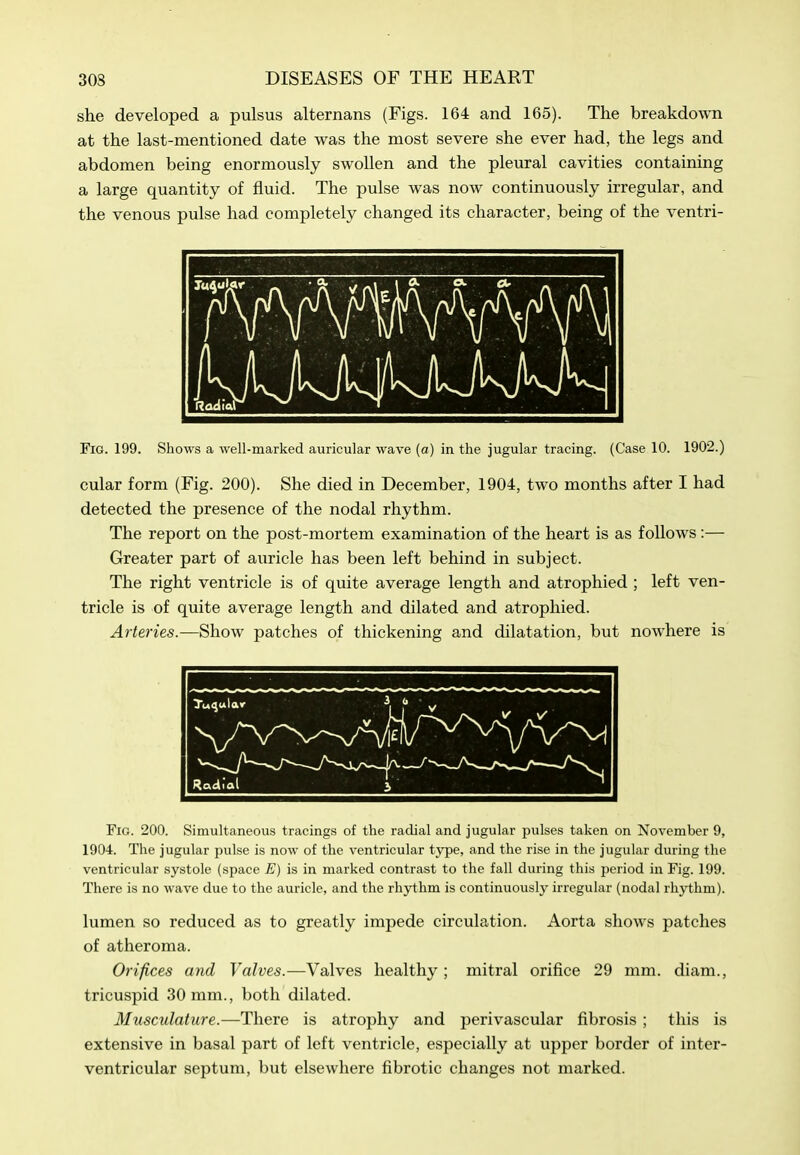 she developed a pulsus alternans (Figs. 164 and 165). The breakdown at the last-mentioned date was the most severe she ever had, the legs and abdomen being enormously swollen and the pleural cavities containing a large quantity of fluid. The pulse was now continuously irregular, and the venous pulse had completely changed its character, being of the ventri- Fig. 199. Shows a well-marked auricular wave (a) in the jugular tracing. (Case 10. 1902.) cular form (Fig. 200). She died in December, 1904, two months after I had detected the presence of the nodal rhythm. The report on the post-mortem examination of the heart is as follows:— Greater part of auricle has been left behind in subject. The right ventricle is of quite average length and atrophied ; left ven- tricle is of quite average length and dilated and atrophied. Arteries.—Show patches of thickening and dilatation, but nowhere is Fig. 200. Simultaneous tracings of the radial and jugular jnilses taken on November 9, 1904. The jugular pulse is now of the ventricular type, and the rise in the jugular during the ventricular systole (space E) is in marked contrast to the fall during this period in Fig. 199. There is no wave due to the auricle, and the rhythm is continuously irregular (nodal rhythm). lumen so reduced as to greatly impede circulation. Aorta shows patches of atheroma. Orifices and Valves.—Valves healthy ; mitral orifice 29 mm. diam., tricuspid 30 mm., both dilated. Musculature.—There is atrophy and perivascular fibrosis; this is extensive in basal part of left ventricle, especially at upper border of inter- ventricular septum, but elsewhere fibrotic changes not marked.