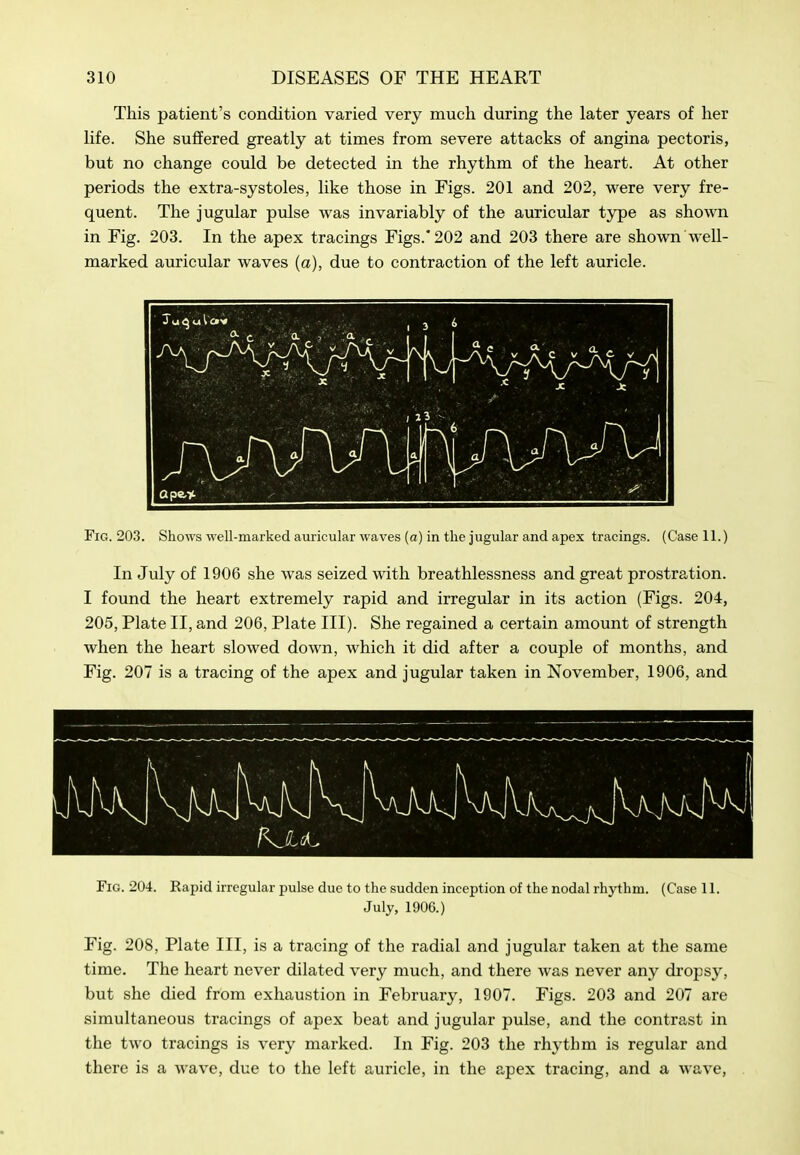 This patient's condition varied very much during the later years of her life. She suffered greatly at times from severe attacks of angina pectoris, but no change could be detected in the rhythm of the heart. At other periods the extra-systoles, like those in Figs. 201 and 202, were very fre- quent. The jugular pulse was invariably of the auricular type as shown in Fig. 203. In the apex tracings Figs.* 202 and 203 there are shown well- marked auricular waves (a), due to contraction of the left auricle. Fig. 203. Shows ■well-marked auricular waves (a) in the jugular and apex tracings. (Case 11.) In July of 1906 she was seized with breathlessness and great prostration. I found the heart extremely rapid and irregular in its action (Figs. 204, 205, Plate II, and 206, Plate III). She regained a certain amount of strength when the heart slowed down, which it did after a couple of months, and Fig. 207 is a tracing of the apex and jugular taken in November, 1906, and Fig. 204. Rapid irregular pulse due to the sudden inception of the nodal rhythm. (Case 11. July, 1906.) Fig. 208, Plate III, is a tracing of the radial and jugular taken at the same time. The heart never dilated very much, and there was never any dropsy, but she died from exhaustion in February, 1907. Figs. 203 and 207 are simultaneous tracings of apex beat and jugular pulse, and the contrast in the two tracings is very marked. In Fig. 203 the rhythm is regular and there is a wave, due to the left auricle, in the apex tracing, and a wave,