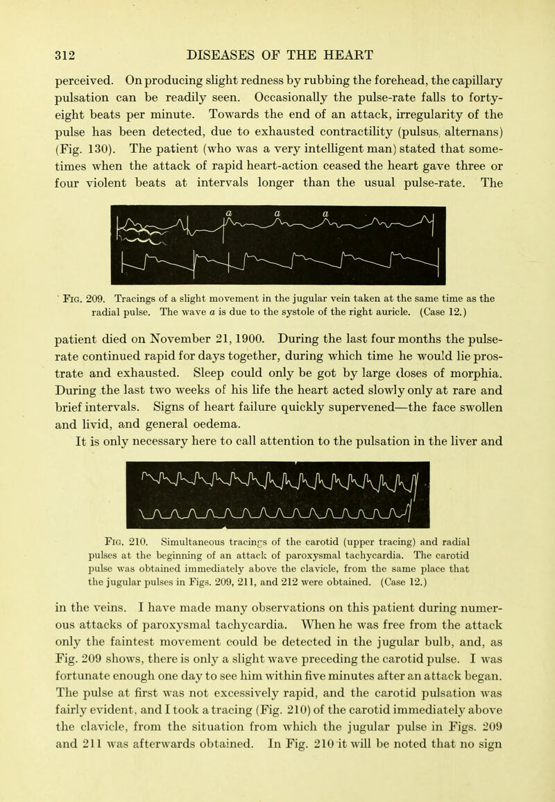 perceived. On producing slight redness by rubbing the forehead, the capillary pulsation can be readily seen. Occasionally the pulse-rate falls to forty- eight beats per minute. Towards the end of an attack, irregularity of the pulse has been detected, due to exhausted contractility (pulsus, alternans) (Fig. 130). The patient (who was a very intelligent man) stated that some- times when the attack of rapid heart-action ceased the heart gave three or four violent beats at intervals longer than the usual pulse-rate. The a a a ' Fig. 209. Tracings of a slight movement in the jugular vein taken at the same time as the radial pulse. The wave a is due to the systole of the right auricle. (Case 12.) patient died on November 21,1900. During the last four months the pulse- rate continued rapid for days together, during which time he would lie pros- trate and exhausted. Sleep could only be got by large closes of morphia. During the last two weeks of his life the heart acted slowly only at rare and brief intervals. Signs of heart failure quickly supervened—the face swollen and livid, and general oedema. It is only necessary here to call attention to the pulsation in the liver and Fig. 210. Simultaneous tracings of the carotid (upper tracing) and radial pulses at the beginning of an attack of paroxysmal tachycardia. The carotid pulse was obtained immediately above the clavicle, from the same place that the jugular pulses in Figs. 209, 211, and 212 were obtained. (Case 12.) in the veins. I have made many observations on this patient during numer- ous attacks of paroxysmal tachycardia. When he was free from the attack only the faintest movement could be detected in the jugular bulb, and, as Fig. 209 shows, there is only a slight wave preceding the carotid pulse. I was fortunate enough one day to see him within five minutes after an attack began. The pulse at first Avas not excessively rapid, and the carotid pulsation Avas fairly evident, and I took a tracing (Fig. 210) of the carotid immediately aboA^e the clavicle, from the situation from Avhich the jugular pulse in Figs. 209 and 211 was afterwards obtained. In Fig. 210 it Avill be noted that no sign