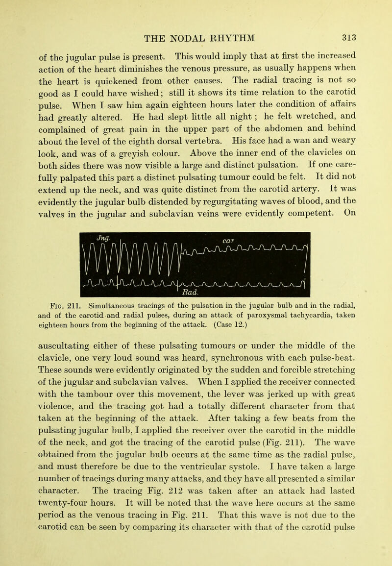 of the jugular pulse is present. This would imply that at first the increased action of the heart diminishes the venous pressure, as usually happens when the heart is quickened from other causes. The radial tracing is not so good as I could have wished; stiU it shows its time relation to the carotid pulse. When I saw him again eighteen hours later the condition of affairs had greatly altered. He had slept httle all night; he felt wretched, and complained of great pain in the upper part of the abdomen and behind about the level of the eighth dorsal vertebra. His face had a wan and weary look, and was of a greyish colour. Above the inner end of the clavicles on both sides there was now visible a large and distinct pulsation. If one care- fully palpated this part a distinct pulsating tumour could be felt. It did not extend up the neck, and was quite distinct from the carotid artery. It was evidently the jugular bulb distended by regurgitating waves of blood, and the valves in the jugular and subclavian veins were evidently competent. On Fig. 211. Simultaneous tracings of the pulsation in the jugular bulb and in the radial, and of the carotid and radial pulses, during an attack of paroxysmal tachycardia, taken eighteen hours from the beginning of the attack. (Case 12.) auscultating either of these pulsating tumours or under the middle of the clavicle, one very loud sound was heard, synchronous with each pulse-beat. These sounds were evidently originated by the sudden and forcible stretching of the jugular and subclavian valves. When I apphed the receiver connected with the tambour over this movement, the lever was jerked up with great violence, and the tracing got had a totally different character from that taken at the beginning of the attack. After taking a few beats from the pulsating jugular bulb, I applied the receiver over the carotid in the middle of the neck, and got the tracing of the carotid pulse (Fig. 211). The wave obtained from the jugular bulb occurs at the same time as the radial pulse, and must therefore be due to the ventricular systole. I have taken a large number of tracings during many attacks, and they have all presented a similar character. The tracing Fig. 212 was taken after an attack had lasted twenty-four hours. It will be noted that the wave here occurs at the same period as the venous tracing in Fig. 211. That this wave is not due to the carotid can be seen by comparing its character with that of the carotid pulse