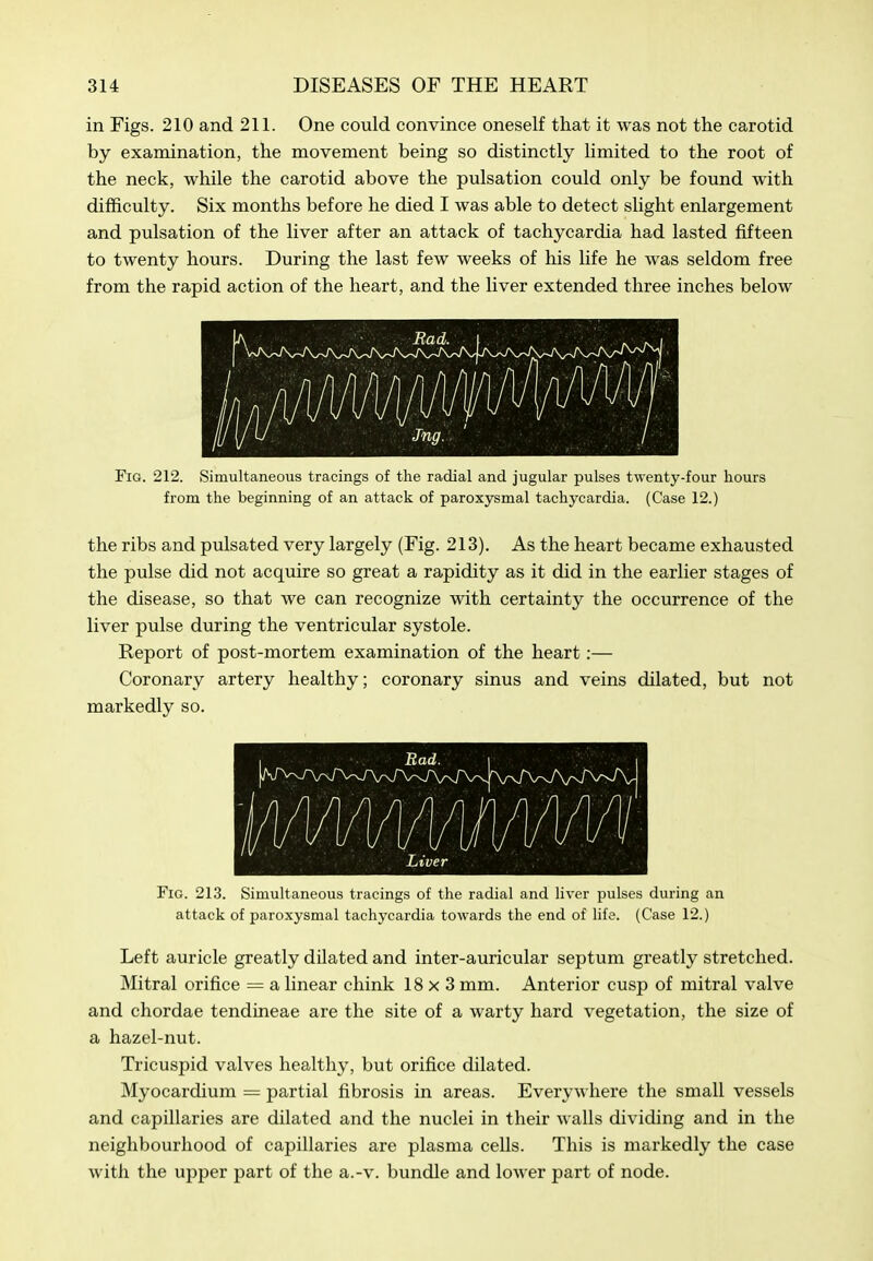 in Figs. 210 and 211. One could convince oneself that it was not the carotid by examination, the movement being so distinctly hmited to the root of the neck, while the carotid above the pulsation could only be found with difficulty. Six months before he died I was able to detect slight enlargement and pulsation of the liver after an attack of tachycardia had lasted fifteen to twenty hours. During the last few weeks of his life he was seldom free from the rapid action of the heart, and the liver extended three inches below Fig. 212. Simultaneous tracings of the radial and jugular pulses twenty-four hours from the beginning of an attack of paroxysmal tachycardia. (Case 12.) the ribs and pulsated very largely (Fig. 213). As the heart became exhausted the pulse did not acquire so great a rapidity as it did in the earlier stages of the disease, so that we can recognize with certainty the occurrence of the liver pulse during the ventricular systole. Report of post-mortem examination of the heart:— Coronary artery healthy; coronary sinus and veins dilated, but not markedly so. Fig. 213. Simultaneous tracings of the radial and liver pulses during an attack of paroxysmal tachycardia towards the end of life. (Case 12.) Left auricle greatly dilated and inter-auricular septum greatly stretched. Mitral orifice = a linear chink 18x3 mm. Anterior cusp of mitral valve and chordae tendineae are the site of a warty hard vegetation, the size of a hazel-nut. Tricuspid valves healthy, but orifice dilated. Myocardium = partial fibrosis in areas. Everywhere the small vessels and capillaries are dilated and the nuclei in their walls dividing and in the neighbourhood of capillaries are plasma cells. This is markedly the case with the upper part of the a.-v. bundle and lower part of node.