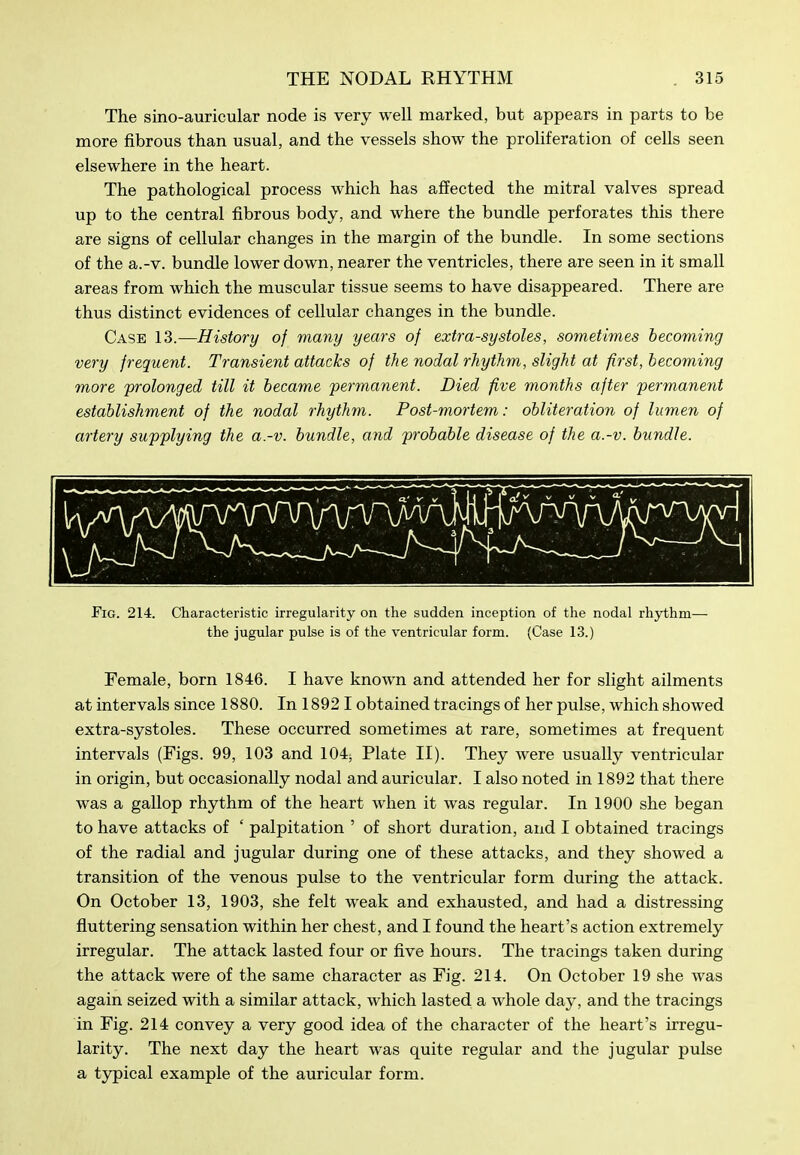 The sino-auricular node is very well marked, but appears in parts to be more fibrous than usual, and the vessels show the proliferation of cells seen elsewhere in the heart. The pathological process which has affected the mitral valves spread up to the central fibrous body, and where the bundle perforates this there are signs of cellular changes in the margin of the bundle. In some sections of the a.-v. bundle lower down, nearer the ventricles, there are seen in it small areas from which the muscular tissue seems to have disappeared. There are thus distinct evidences of cellular changes in the bundle. Case 13.—History of many years of extra-systoles, sometimes becoming very frequent. Transient attacks of the nodal rhythm, slight at first, becoming more prolonged till it became 'permanent. Died five months after permanent establishment of the nodal rhythm. Post-mortem: obliteration of lumen of artery supplying the a.-v. bundle, and probable disease of the a.-v. bundle. Fig. 214. Characteristic irregularity on the sudden inception of the nodal rhythm— the jugular pulse is of the ventricular form. (Case 13.) Female, born 1846. I have known and attended her for slight ailments at intervals since 1880. In 18921 obtained tracings of her pulse, which showed extra-systoles. These occurred sometimes at rare, sometimes at frequent intervals (Figs. 99, 103 and 104j Plate II). They were usually ventricular in origin, but occasionally nodal and auricular. I also noted in 1892 that there was a gallop rhythm of the heart when it was regular. In 1900 she began to have attacks of ' palpitation ' of short duration, and I obtained tracings of the radial and jugular during one of these attacks, and they showed a transition of the venous pulse to the ventricular form during the attack. On October 13, 1903, she felt weak and exhausted, and had a distressing fluttering sensation within her chest, and I found the heart's action extremely irregular. The attack lasted four or five hours. The tracings taken during the attack were of the same character as Fig. 214. On October 19 she was again seized with a similar attack, which lasted a whole day, and the tracings in Fig. 214 convey a very good idea of the character of the heart's irregu- larity. The next day the heart was quite regular and the jugular pulse a typical example of the auricular form.