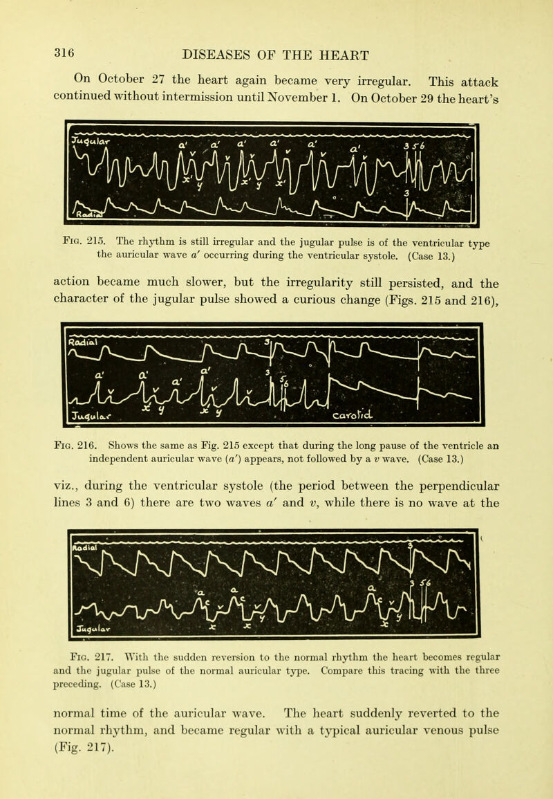 On October 27 the heart again became very irregular. This attack continued without intermission until November 1. On October 29 the heart's Fig. 215. The rh}rthm is still irregular and the jugular pulse is of the ventricular type the auricular wave a' occurring during the ventricular systole. (Case 13.) action became much slower, but the irregularity still persisted, and the character of the jugular pulse showed a curious change (Figs. 215 and 216), (1 \ ^<> n \a JJl l Cafo^icL Fig. 216. Shows the same as Fig. 215 except that during the long pause of the ventricle an independent auricular wave (a') appears, not followed by a v wave. (Case 13.) viz., during the ventricular systole (the period between the perpendicular lines 3 and 6) there are two waves a' and v, while there is no wave at the Ju^ulav Fig. 217. With the sudden reversion to the normal rhythm the heart becomes regular and the jugular pulse of the normal auricular type. Compare this tracing with the three preceding. (Case 13.) normal time of the auricular Avave. The heart suddenly reverted to the normal rhythm, and became regular with a typical auricular venous pulse (Fig. 217).