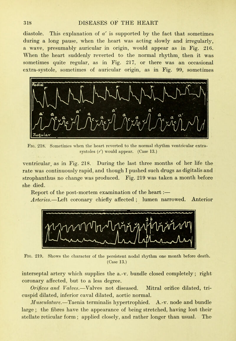 diastole. This explanation of a' is supported by the fact that sometimes during a long pause, when the heart was acting slowly and irregularly, a wave, presumably auricular in origin, would appear as in Fig. 216. When the heart suddenly reverted to the normal rhythm, then it was sometimes quite regular, as in Fig. 217, or there was an occasional extra-systole, sometimes of auricular origin, as in Fig. 99, sometimes Fig. 218. Sometimes when the heart reverted to the normal rhjrthm ventricular extra- systoles (r') would appear. (Case 13.) ventricular, as in Fig. 218. During the last three months of her life the rate was continuously rapid, and though I pushed such drugs as digitalis and strophanthus no change was produced. Fig. 219 was taken a month before she died. Report of the post-mortem examination of the heart:— Arteries.—Left coronary chiefly affected ; lumen narrowed. Anterior Fig. 219. Shows the character of the persistent nodal rhythm one month before death. (Case 13.) interseptal artery which supplies the a.-v. bundle closed completely; right coronary affected, but to a less degree. Orifices and Valves.—Valves not diseased. Mitral orifice dilated, tri- cuspid dilated, inferior caval dilated, aortic normal. Musculature.—Taenia terminalis hypertrophied. A.-v. node and bundle large ; the fibres have the appearance of being stretched, having lost their stellate reticular form ; applied closely, and rather longer than usual. The
