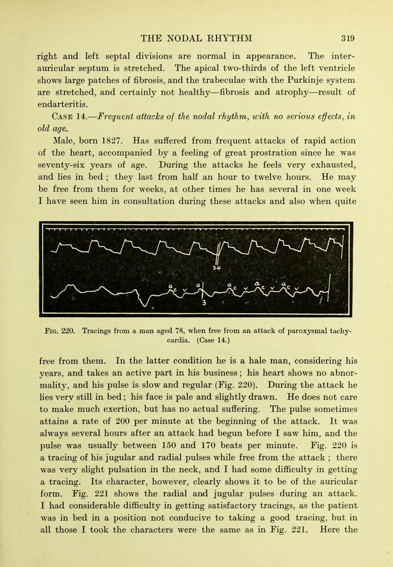 right and left septal divisions are normal in appearance. The inter- auricular septum is stretched. The apical two-thirds of the left ventricle shows large patches of fibrosis, and the trabeculae with the Purkinje system are stretched, and certainly not healthy—fibrosis and atrophy—result of endarteritis. Case 14.—Frequent attacks of the nodal rhythm, with no serious effects, in old age. Male, born 1827. Has suffered from frequent attacks of rapid action of the heart, accompanied by a feeling of great prostration since he was seventy-six years of age. During the attacks he feels very exhausted, and lies in bed ; they last from half an hour to twelve hours. He may be free from them for weeks, at other times he has several in one week I have seen him in consultation during these attacks and also when quite Fig. 220. Tracings from a man aged 78, when free from an attack of paroxysmal tachy- cardia. (Case 14.) free from them. In the latter condition he is a hale man, considering his years, and takes an active part in his business; his heart shows no abnor- mality, and his pulse is slow and regular (Fig. 220). During the attack he Hes very still in bed; his face is pale and slightly drawn. He does not care to make much exertion, but has no actual suflfering. The pulse sometimes attains a rate of 200 per minute at the beginning of the attack. It was always several hours after an attack had begun before I saw him, and the pulse was usually between 150 and 170 beats per minute. Fig. 220 is a tracing of his jugular and radial pulses while free from the attack ; there was very slight pulsation in the neck, and I had some difficulty in getting a tracing. Its character, however, clearly shows it to be of the auricular form. Fig. 221 shows the radial and jugular pulses during an attack. I had considerable difficulty in getting satisfactory tracings, as the patient Avas in bed in a position not conducive to taking a good tracing, but in all those I took the characters were the same as in Fig. 221. Here the