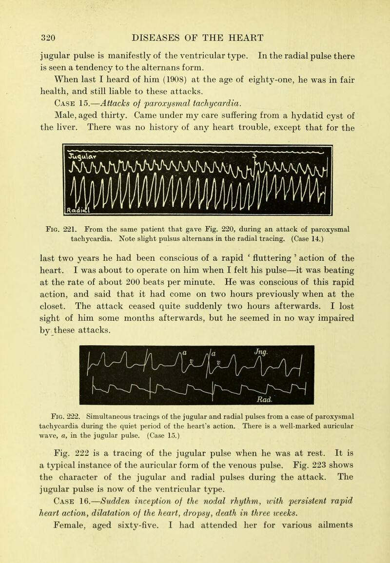 jugular pulse is manifestly of the ventricular type. In the radial pulse there is seen a tendency to the alternans form. When last I heard of him (1908) at the age of eighty-one, he was in fair health, and still liable to these attacks. Case 15.—Attacks of paroxysmal tachycardia. Male, aged thirty. Came under my care suffering from a hydatid cyst of the liver. There was no history of any heart trouble, except that for the Fig. 221. From the same patient that gave Fig. 220, during an attack of paroxysmal tachycardia. Note shght pulsus alternans in the radial tracing. (Case 14.) last two years he had been conscious of a rapid ' fluttering ' action of the heart. I was about to operate on him when I felt his pulse—it was beating at the rate of about 200 beats per minute. He was conscious of this rapid action, and said that it had come on two hours previously when at the closet. The attack ceased quite suddenly two hours afterwards. I lost sight of him some months afterwards, but he seemed in no way impaired by these attacks. Rad. Fig. 222. Simultaneous tracings of the jugular and radial pulses from a case of paroxysmal tachycardia during the quiet period of the heart's action. There is a well-marked auricular wave, a, in the jugular pulse. (Case 15.) Fig. 222 is a tracing of the jugular pulse when he was at rest. It is a typical instance of the auricular form of the venous pulse. Fig. 223 shows the character of the jugular and radial pulses during the attack. The jugular pulse is now of the ventricular type. Case 16.—Sudden inception of the nodal rhythm, with persistent rapid heart action, dilatation of the heart, dropsy, death in three iceeks. Female, aged sixty-five. I had attended her for various ailments