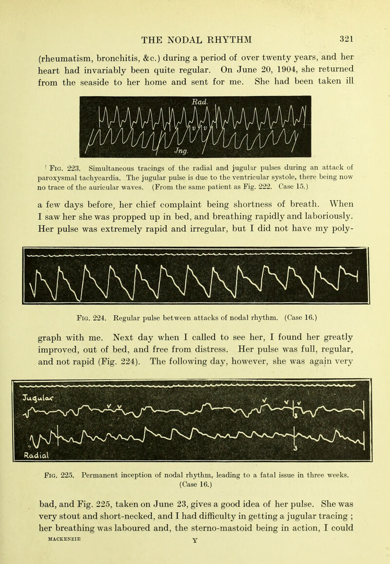 (rheumatism, bronchitis, &c.) during a period of over twenty years, and her heart had invariably been quite regular. On June 20, 1904, she returned from the seaside to her home and sent for me. She had been taken ill ' Fig. 223. Simultaneous tracings of the radial and jugular pulses during an attack of paroxysmal tachycardia. The jugular pulse is due to the ventricular systole, there being now no trace of the auricular waves. (From the same patient as Fig. 222. Case 15.) a few days before, her chief complaint being shortness of breath. When I saw her she was propped up in bed, and breathing rapidly and laboriously. Her pulse was extremely rapid and irregular, but I did not have my poly- FiG. 224. Regular pulse between attacks of nodal rhythm. (Case 16.) graph with me. Next day when I called to see her, I found her greatly improved, out of bed, and free from distress. Her pulse was full, regular, and not rapid (Fig. 224). The following day, however, she was again very Fig. 225. Permanent inception of nodal rhjrthm, leading to a fatal issue in three weeks. (Case 16.) bad, and Fig. 225, taken on June 23, gives a good idea of her pulse. She was very stout and short-necked, and I had difficulty in getting a jugular tracing ; her breathing was laboured and, the sterno-mastoid being in action, I could MACKENZIE V