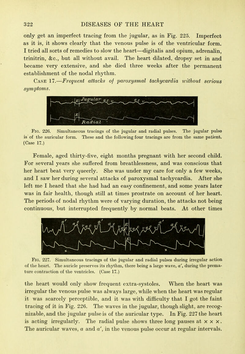 only get an imperfect tracing from the jugular, as in Fig. 225. Imperfect as it is, it shows clearly that the venous pulse is of the ventricular form. I tried all sorts of remedies to slow the heart—digitalis and opium, adrenalin, trinitrin, &c., but all without avail. The heart dilated, dropsy set in and became very extensive, and she died three weeks after the permanent establishment of the nodal rhythm. Case 17.—Frequent attacks of 'paroxysmal tachycardia ivithout serious symptoms. Fig. 226. Simultaneous tracings of the jugular and radial pulses. The jugular pulse is of the auricular form. These and the following four tracings are from the same patient. (Case 17.) Female, aged thirty-five, eight months pregnant with her second child. For several years she suffered from breathlessness, and was conscious that her heart beat very queerly. She was under my care for only a few weeks, and I saw her during several attacks of paroxysmal tachycardia. After she left me I heard that she had had an easy confinement, and some years later was in fair health, though still at times prostrate on account of her heart. The periods of nodal rhythm were of varying duration, the attacks not being continuous, but interrupted frequently by normal beats. At other times Fig. 227. Simultaneous tracings of the jugular and radial pulses during irregular action of the heart. The auricle jireserves its rhythm, there being a large wave, a', during the prema- ture contraction of the ventricles. (Case 17.) the heart would only show frequent extra-systoles. When the heart was irregular the venous pulse was always large, while when the heart was regular it was scarcely perceptible, and it was with difficulty that I got the faint tracing of it in Fig. 226. The waves in the jugular, though slight, are recog- nizable, and the jugular pulse is of the auricular type. In Fig. 227 the heart is acting irregularly. The radial pulse shows three long pauses at x x x. The auricular waves, a and a', in the venous pulse occur at regular intervals.