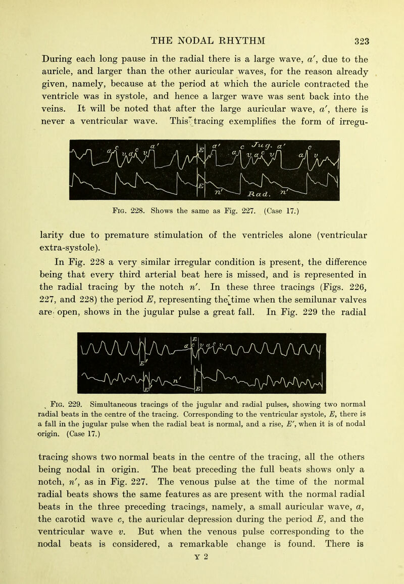 During each long pause in the radial there is a large wave, a', due to the auricle, and larger than the other auricular waves, for the reason already given, namely, because at the period at which the auricle contracted the ventricle was in systole, and hence a larger wave was sent back into the veins. It will be noted that after the large auricular wave, a', there is never a ventricular wave. ThisTtracing exemplifies the form of irregu- Fig. 228. Shows the same as Fig. 227. (Case 17.) larity due to premature stimulation of the ventricles alone (ventricular extra-systole). In Fig. 228 a very similar irregular condition is present, the difference being that every third arterial beat here is missed, and is represented in the radial tracing by the notch n'. In these three tracings (Figs. 226, 227, and 228) the period E, representing the^^time when the semilunar valves are' open, shows in the jugular pulse a great fall. In Fig. 229 the radial Fig. 229. Simultaneous tracings of the jugular and radial pulses, showing two normal radial beats in the centre of the tracing. Corresponding to the ventricular systole, E, there is a fall in the jugular pulse when the radial beat is normal, and a rise, E', when it is of nodal origin. (Case 17.) tracing shows two normal beats in the centre of the tracing, all the others being nodal in origin. The beat preceding the full beats shows only a notch, n', as in Fig. 227. The venous pulse at the time of the normal radial beats shows the same features as are present with the normal radial beats in the three preceding tracings, namely, a small auricular wave, a, the carotid wave c, the auricular depression during the period and the ventricular wave v. But when the venous pulse corresponding to the nodal beats is considered, a remarkable change is found. There is
