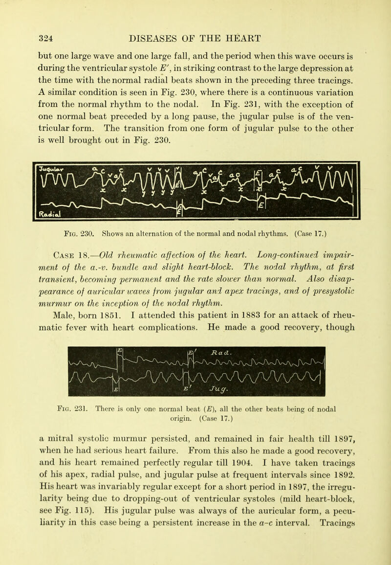 but one large wave and one large fall, and the period when this wave occurs is during the ventricular systole E', in striking contrast to the large depression at the time with the normal radial beats shown in the preceding three tracings. A similar condition is seen in Fig. 230, where there is a continuous variation from the normal rhythm to the nodal. In Fig. 231, with the exception of one normal beat preceded by a long pause, the jugular pulse is of the ven- tricular form. The transition from one form of jugular pulse to the other is well brought out in Fig. 230. Fig. 230. Shows an alternation of the normal and nodal rhythms. (Case 17.) Case 18.—Old rheumatic affection of the heart. Long-continued impair- ment of the a.-v. bundle and slight heart-block. The nodal rhythm, at first transient, becoming permanent and the rate slower than normal. Also disap- pearance of auricular leaves from jugular and apex tracings, and of presystolic murmur on the inception of the nodal rhythm. Male, born 1851. I attended this patient in 1883 for an attack of rheu- matic fever with heart complications. He made a good recovery, though Fig. 231. There is only one normal beat {E), all the other beats being of nodal origin. (Case 17.) a mitral systoHc murmur persisted, and remained in fair health till 1897, when he had serious heart failure. From this also he made a good recovery, and his heart remained perfectly regular till 1904. I have taken tracings of his apex, radial pulse, and jugular pulse at frequent intervals since 1892. His heart was invariably regular except for a short period in 1897, the irregu- larity being due to dropping-out of ventricular systoles (mild heart-block, see Fig. 115). His jugular pulse was always of the auricular form, a pecu- liarity in this case being a persistent increase in the a-c interval. Tracings