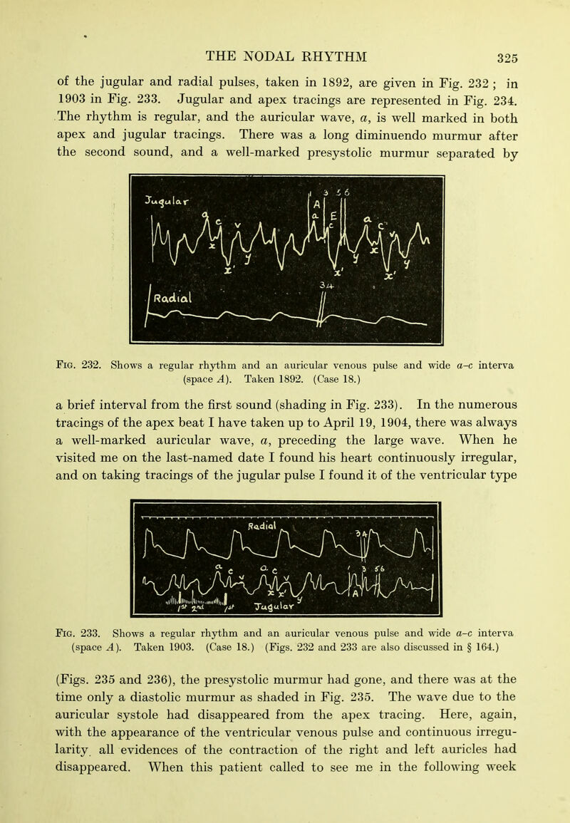 of the jugular and radial pulses, taken in 1892, are given in Fig. 232 ; in 1903 in Fig. 233. Jugular and apex tracings are represented in Fig. 234. The rhythm is regular, and the auricular wave, a, is well marked in both apex and jugular tracings. There was a long diminuendo murmur after the second sound, and a well-marked presystolic murmur separated by Fig. 232. Shows a regular rhythm and an auricular venous pulse and wide a-c interva (space A). Taken 1892. (Case 18.) a brief interval from the first sound (shading in Fig. 233). In the numerous tracings of the apex beat I have taken up to April 19, 1904, there was always a well-marked auricular wave, a, preceding the large wave. When he visited me on the last-named date I found his heart continuously irregular, and on taking tracings of the jugular pulse I found it of the ventricular type Fig. 233. Shows a regular rhythm and an auricular venous pulse and wide a-c interva (space A). Taken 1903. (Case 18.) (Figs. 232 and 233 are also discussed in § 164.) (Figs. 235 and 236), the presystolic murmur had gone, and there was at the time only a diastolic murmur as shaded in Fig. 235. The wave due to the auricular systole had disappeared from the apex tracing. Here, again, with the appearance of the ventricular venous pulse and continuous irregu- larity all evidences of the contraction of the right and left auricles had disappeared. When this patient called to see me in the following week