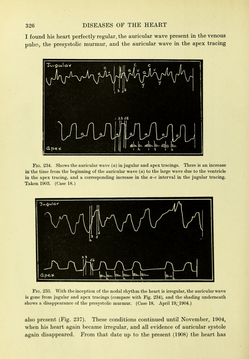 I found his heart perfectly regular, the auricular wave present in the venous pulse, the presystolic murmur, and the auricular wave in the apex tracing Fig. 234. Shows the auricular wave (a) in jugular and apex tracings. There is an increase in the time from the beginning of the auricular wave (a) to the large wave due to the ventricle in the apex tracing, and a corresponding increase in the a-c interval in the jugular tracing. Taken 1903. (Case 18.) Fig. 235. With the inception of the nodal rhythm the heart is irregular, the auricular wave is gone from jugular and apex tracings (compare with Fig. 234), and the shading underneath shows a disappearance of the presystoUc murmur. (Case 18. April 19,'_1904.) also present (Fig. 237). These conditions continued until November, 1904, when his heart again became irregular, and all evidence of auricular systole again disappeared. From that date up to the present (1908) the heart has