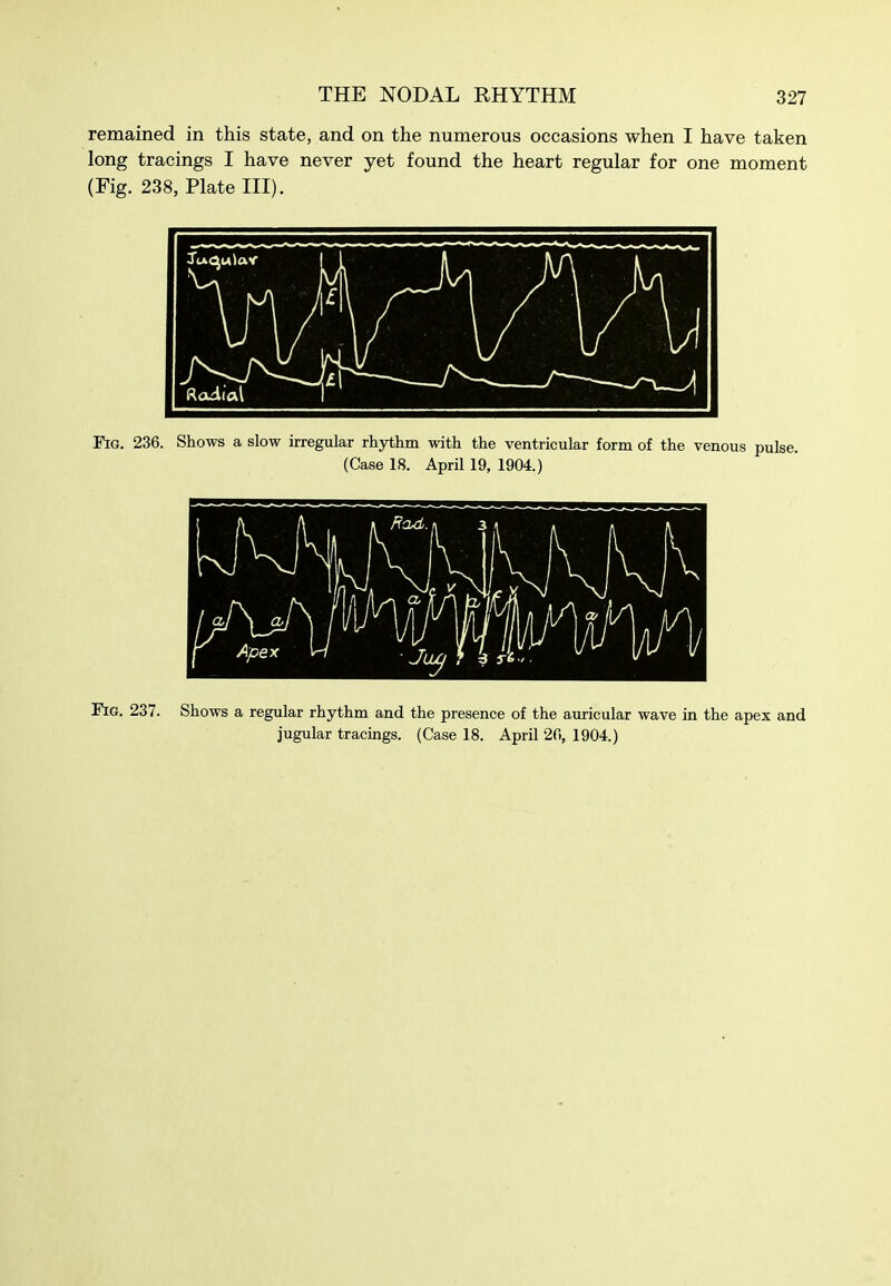 remained in this state, and on the numerous occasions when I have taken long tracings I have never yet found the heart regular for one moment (Fig. 238, Plate III). Fig. 236. Shows a slow irregular rhythm with the ventricular form of the venous puis (Case 18. April 19, 1904.) Fig. 237. Shows a regular rhythm and the presence of the auricular wave in the apex and jugular tracings. (Case 18. April 2fl, 1904.)