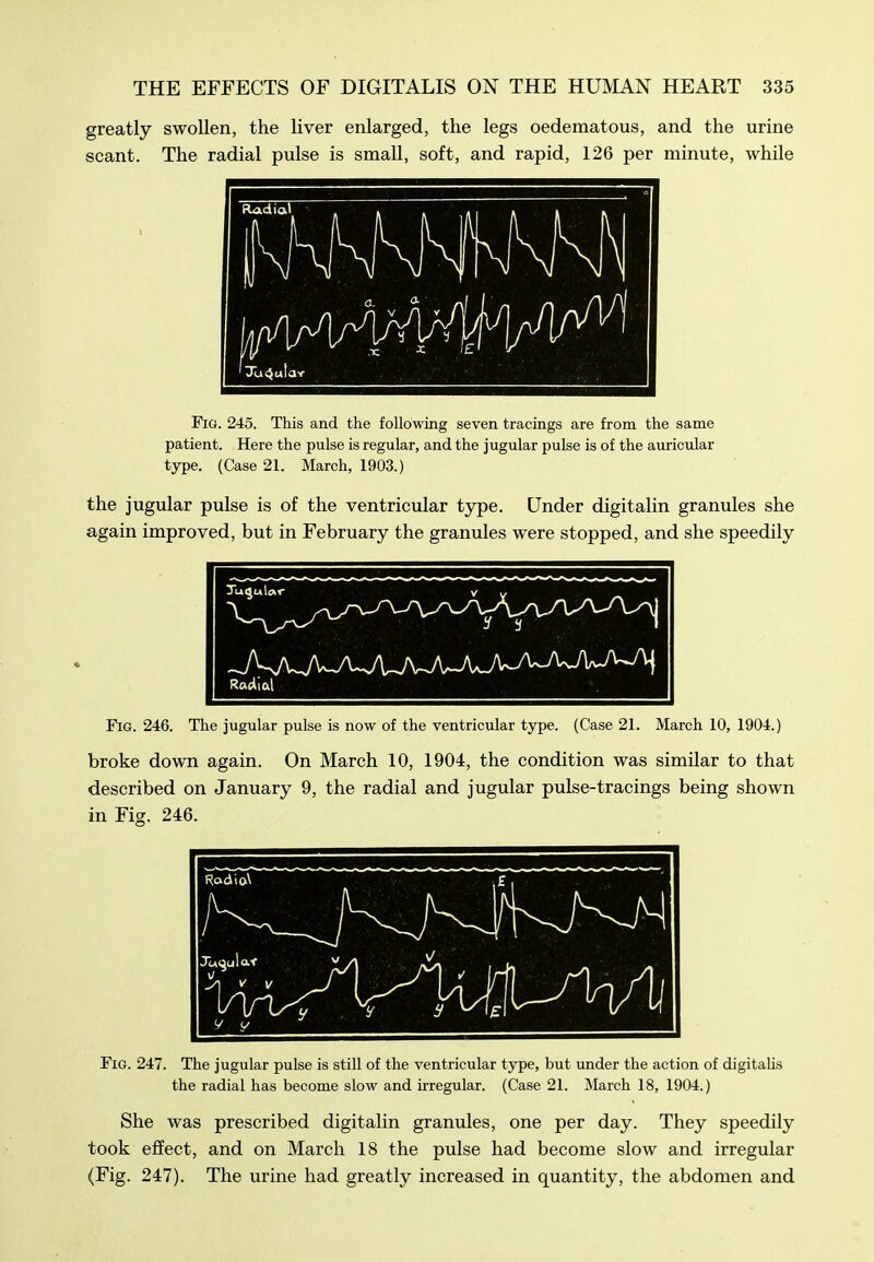 greatly swollen, the liver enlarged, the legs oedematous, and the urine scant. The radial pulse is small, soft, and rapid, 126 per minute, while Fig. 245. This and the following seven tracings are from the same patient. Here the pulse is regular, and the jugular pulse is of the auricular type. (Case 21. March, 1903.) the jugular pulse is of the ventricular type. Under digitalin granules she again improved, but in February the granules were stopped, and she speedily Fig. 246. The jugular pulse is now of the ventricular type. (Case 21. March 10, 1904.) broke down again. On March 10, 1904, the condition was similar to that described on January 9, the radial and jugular pulse-tracings being shown in Fis. 246. Fig. 247. The jugular pulse is still of the ventricular type, but under the action of digitalis the radial has become slow and irregular. (Case 21. March 18, 1904.) She was prescribed digitalin granules, one per day. They speedily took effect, and on March 18 the pulse had become slow and irregular (Fig. 247). The urine had greatly increased in quantity, the abdomen and