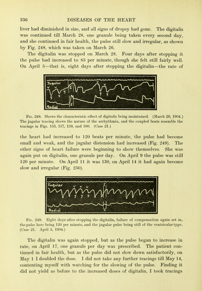 liver had diminished in size, and all signs of dropsy had gone. The digitalis was continued till March 28, one granule being taken every second day, and she continued in fair health, the pulse still slow and irregular, as shown by Fig. 248, which was taken on March 26. The digitalin was stopped on March 28. Four days after stopping it the pulse had increased to 85 per minute, though she felt still fairly well. On April 5—that is, eight days after stopping the digitalin—the rate of Fig. 248. Shows the characteristic effect of digitahs being maintained. (March 26, 1904.) The jugular tracing shows the nature of the arrhythmia, and the coupled beats resemble the tracmgs in Figs. 153, 157, 159, and 160. (Case 21.) the heart had increased to 120 beats per minute, the pulse had become small and weak, and the jugular distension had increased (Fig. 249). The other signs of heart failure were beginning to show themselves. She was again put on digitalin, one granule per day. On April 9 the pulse was still 120 per minute. On April 11 it was 130, on April 14 it had again become slow and irregular (Fig. 250). Fig. 249. Eight days after stopping the digitalin, failure of compensation again set in, the pulse here being 120 per minute, and the jugular pulse being still of the ventricular type. (Case 21. April 5, 1904.) The digitalin was again stopped, but as the pulse began to increase in rate, on April 17, one granule per day was prescribed. The patient con- tinued in fair health, but as the pulse did not slow down satisfactorily, on May 1 I doubled the dose. I did not take any further tracings till May 14, contenting myself with watching for the slowing of the pulse. Finding it did not yield as before to the increased doses of digitalin, I took tracings