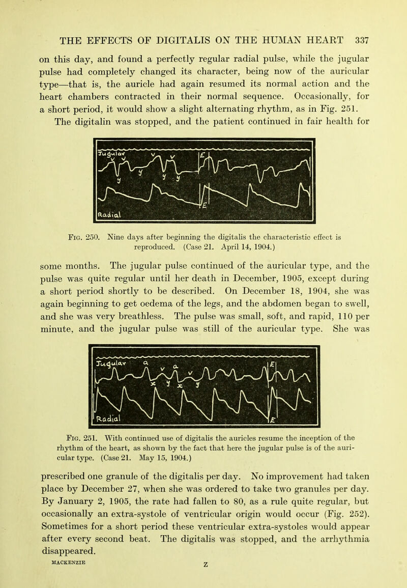 on this day, and found a perfectly regular radial pulse, while the jugular pulse had completely changed its character, being now of the auricular type—that is, the auricle had again resumed its normal action and the heart chambers contracted in their normal sequence. Occasionally, for a short period, it would show a slight alternating rhythm, as in Fig. 251. The digitalin was stopped, and the patient continued in fair health for R.adlia\ Fig. 250. Nine days after beginning the digitalis the characteristic effect is reproduced. (Case 21. April 14, 1904.) some months. The jugular pulse continued of the auricular type, and the pulse was quite regular until her death in December, 1905, except during a short period shortly to be described. On December 18, 1904, she was again beginning to get oedema of the legs, and the abdomen began to swell, and she was very breathless. The pulse was small, soft, and rapid, 110 per minute, and the jugular pulse was still of the auricular type. She was Fig. 251. With continued use of digitalis the auricles resume the inception of the rhythm of the heart, as sho^vn by the fact that here the jugular pulse is of the auri- cular type. (Case 21. May 15, 1904.) prescribed one granule of the digitalis per day. No improvement had taken place by December 27, when she was ordered to take two granules per day. By January 2, 1905, the rate had fallen to 80, as a rule quite regular, but occasionally an extra-systole of ventricular origin would occur (Fig. 252). Sometimes for a short period these ventricular extra-systoles would appear after every second beat. The digitalis was stopped, and the arrhythmia disappeared. UACEENZIE 1/