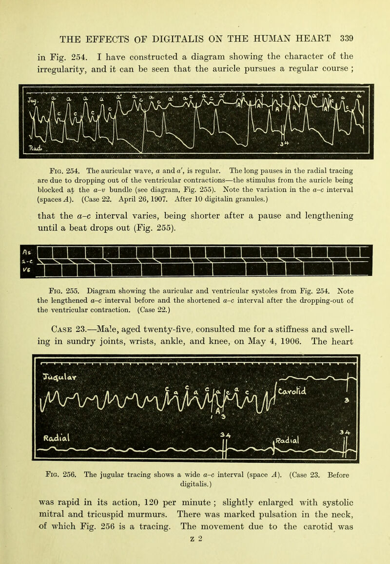 in Fig. 254. I have constructed a diagram showing the character of the irregularity, and it can be seen that the auricle pursues a regular course ; Fig. 254. The auricular wave, a and a', is regular. The long pauses in the radial tracing are due to dropping out of the ventricular contractions—the stimulus from the auricle being blocked at the a-v bundle (see diagram, Fig. 255). Note the variation in the a-c interval (spaces A). (Case 22. April 26,1907. After 10 digitalin granules.) that the a-c interval varies, being shorter after a pause and lengthening until a beat drops out (Fig. 255). Fig. 255. Diagram showing the auricular and ventricular systoles from Fig. 254. Note the lengthened a-c interval before and the shortened a-c interval after the dropping-out of the ventricular contraction. (Case 22.) Case 23.—Male, aged twenty-five, consulted me for a stiffness and swell- ing in sundry joints, wrists, ankle, and knee, on May 4, 1906. The heart Fig. 256. The jugular tracing shows a wide a-c interval (space A). (Case 23. Before digitahs.) was rapid in its action, 120 per minute ; slightly enlarged with systolic mitral and tricuspid murmurs. There was marked pulsation in the neck, of which Fig. 256 is a tracing. The movement due to the carotid was z 2