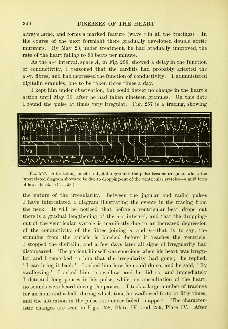 always large, and forms a marked feature (wave c in aU the tracings). In the course of the next fortnight there gradually developed double aortic murmurs. By May 23, under treatment, he had gradually improved, the rate of the heart falUng to 90 beats per minute. As the a-c interval, spaced, in Fig. 256, showed a delay in the function of conductivity, I reasoned that the carditis had probably affected the a.-v. fibres, and had depressed the function of conductivity. I administered digitahn granules, one to be taken three times a day. I kept him under observation, but could detect no change in the heart's action until May 30, after he had taken nineteen granules. On this date I found the pulse at times very irregular. Fig. 257 is a tracing, showing Fig. 257. After taking nineteen digitalin granules the pulse became irregular, which the intercalated diagi'am shows to be due to dropping-out of the ventricular systoles—a mild form of heart-block. (Case 23.) the nature of the irregularity. Between the jugular and radial pulses I have intercalated a diagram illustrating the events in the tracing from the neck. It will be noticed that before a ventricular beat drops out there is a gradual lengthening of the a-c interval, and that the dropping- out of the ventricular systole is manifestly due to an increased depression of the conductivity of the fibres joining a and v—that is to say, the stimulus from the auricle is blocked before it reaches the ventricle. I stopped the digitalin, and a few days later all signs of irregularity had disappeared. The patient himself was conscious when his heart was irregu- lar, and I remarked to him that the irregularity had gone ; he repHed, ' I can bring it back.' I asked him how he could do so, and he said, ' By swallowing.' I asked him to swallow, and he did so, and immediately I detected long pauses in his pulse, while, on auscultation of the heart, no sounds were heard during the pauses. I took a large number of tracings for an hour and a half, during which time he swallowed forty or fifty times, and the alteration in the pulse-rate never failed to appear. The character- istic changes are seen in Figs. 258, Plate IV, and 259, Plate IV. After