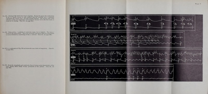Fig. 265. Slowing of the whole heart due to digitalis. During the pauses the conductivity of the o-r bundle became so well restored that the auricular wave a gradually approached the carotid wave r till they became blended. The murmur due to the auricular systoles also approaches and seemed to become lost in the first sound, as shown by the shading. (Case 24 ; see page 341.) Fig. 266. Extra-systoles, r, probably of ventiicular origin, due to digitalis. The waves i>' axe due to the extx-a-systole. There are occasional long pauses when no extrarsystole occurred, followed by a shortening of the a-c interval. (Case 24 ; see page 344.) Fig. 267 is a continuation of Fig. 266 and shows the same kinds of irregularity. (Case 24; see page 344.) Fig. 268. Shows the irregularity and ventricular form of venous pulse characteristic of the nodal rhythm which finally became jjermanent in this patient. (Case 24; see page 344.)