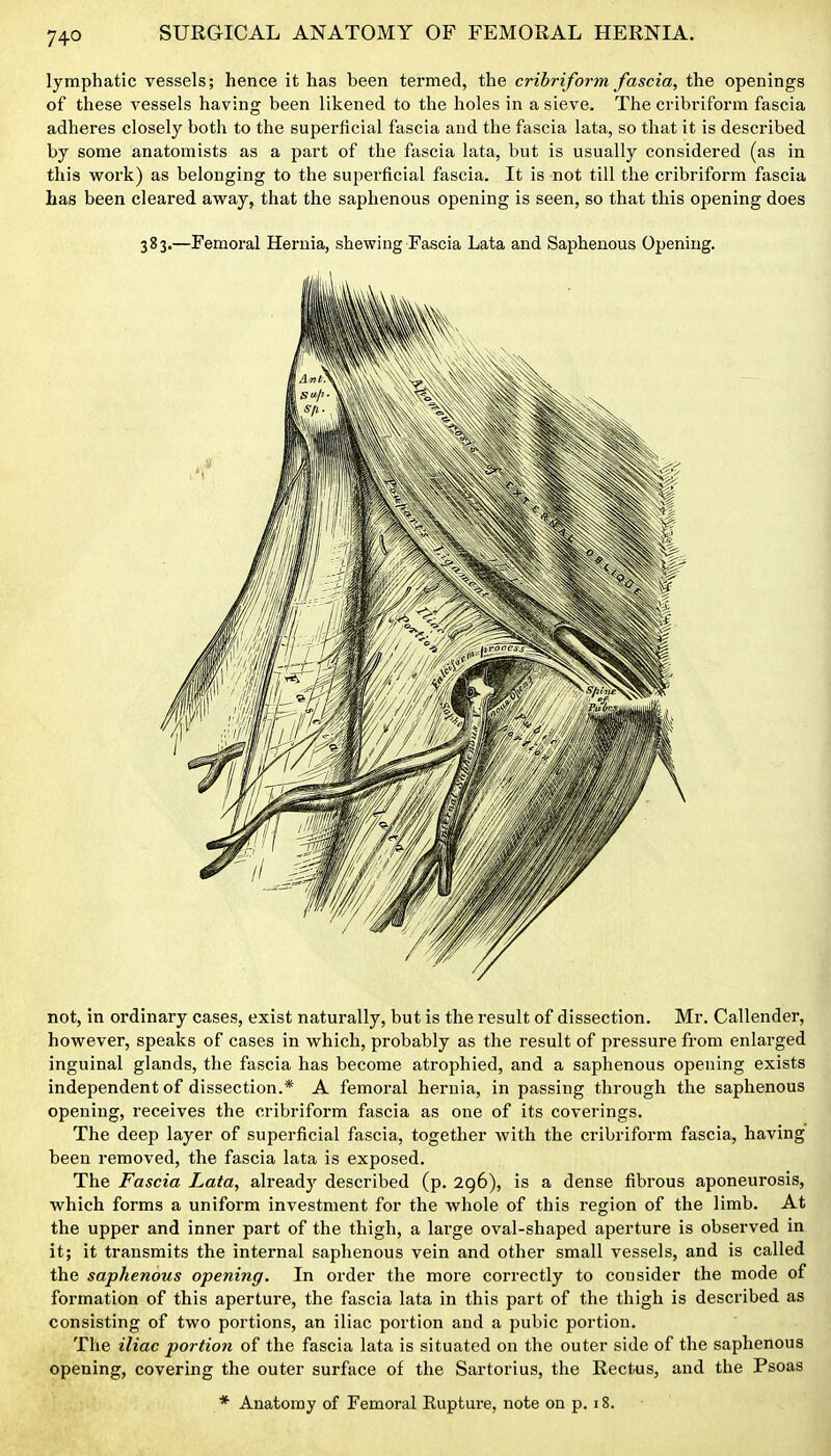 lymphatic vessels; hence it has been termed, the cribriform fascia, the openings of these vessels having been likened to the holes in a sieve. The cribriform fascia adheres closely both to the superficial fascia and the fascia lata, so that it is described by some anatomists as a part of the fascia lata, but is usually considered (as in this work) as belonging to the superficial fascia. It is not till the cribriform fascia has been cleared away, that the saphenous opening is seen, so that this opening does 383.—Femoral Hernia, shewing Fascia Lata and Saphenous Opening. not, in ordinary cases, exist naturally, but is the result of dissection. Mr. Callender, however, speaks of cases in which, probably as the result of pressure from enlarged inguinal glands, the fascia has become atrophied, and a saphenous opening exists independent of dissection.* A femoral hernia, in passing through the saphenous opening, receives the cribriform fascia as one of its coverings. The deep layer of superficial fascia, together with the cribriform fascia, having been removed, the fascia lata is exposed. The Fascia Lata, already described (p. 296), is a dense fibrous aponeurosis, which forms a unifoi'm investment for the whole of this region of the limb. At the upper and inner part of the thigh, a large oval-shaped aperture is observed in it; it transmits the internal saphenous vein and other small vessels, and is called the saphenous opening. In order the more correctly to consider the mode of formation of this aperture, the fascia lata in this part of the thigh is described as consisting of two portions, an iliac portion and a pubic portion. The iliac portion of the fascia lata is situated on the outer side of the saphenous opening, covering the outer surface of the Sartorius, the Rectus, and the Psoas * Anatomy of Femoral Rupture, note on p. 18.