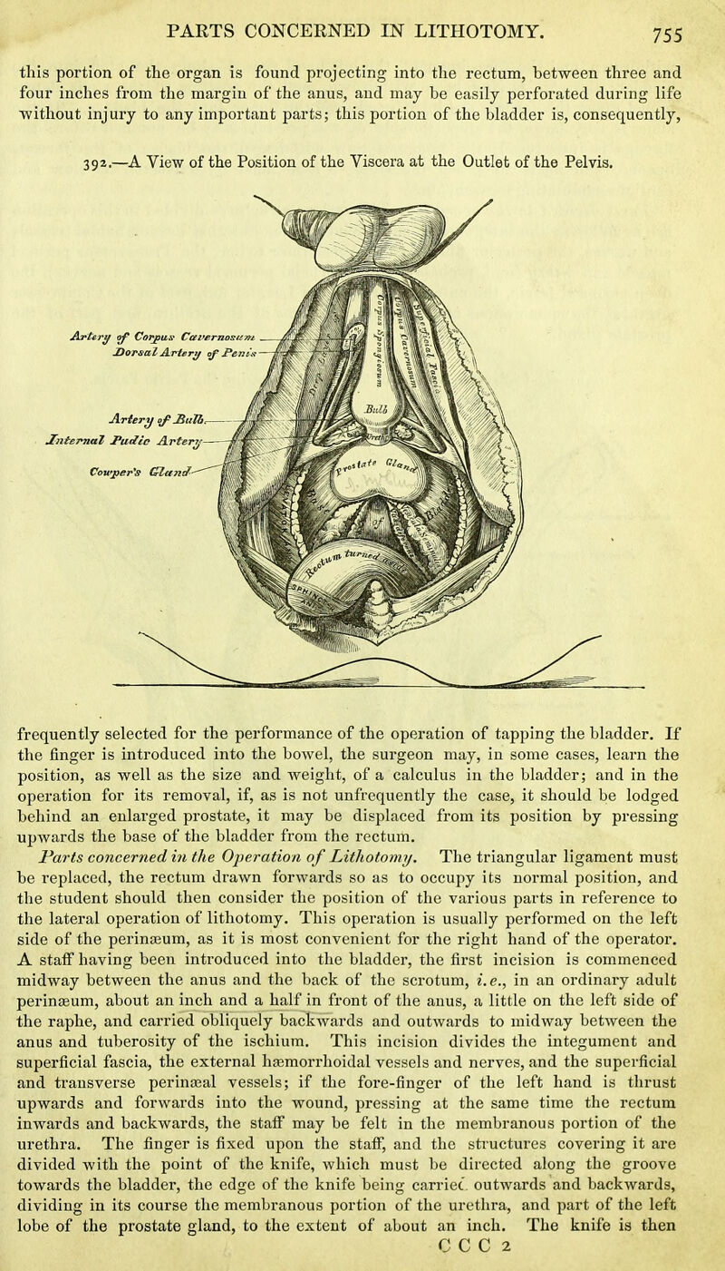 PARTS CONCERNED IN LITHOTOMY. this portion of the organ is found projecting into the rectum, between three and four inches from the margin of the anus, and may be easily perforated during life without injury to any important parts; this portion of the bladder is, consequently, 392.—A View of the Position of the Viscera at the Outlet of the Pelvis. frequently selected for the performance of the operation of tapping the bladder. If the finger is introduced into the bowel, the surgeon may, in some cases, learn the position, as well as the size and weight, of a calculus in the bladder; and in the operation for its removal, if, as is not unfrequently the case, it should be lodged behind an enlarged prostate, it may be displaced from its position by pressing upwards the base of the bladder from the rectum. Parts concerned in the Oj)eration of Lithotomy. The triangular ligament must be replaced, the rectum drawn forwards so as to occupy its normal position, and the student should then consider the position of the various parts in reference to the lateral operation of lithotomy. This operation is usually performed on the left side of the perinseum, as it is most convenient for the right hand of the operator. A staff having been introduced into the bladder, the first incision is commenced midway between the anus and the back of the scrotum, i.e., in an ordinary adult perinasum, about an inch and a half in front of the anus, a little on the left side of the raphe, and carried obliquely backwards and outwards to midway between the anus and tuberosity of the ischium. This incision divides the integument and superficial fascia, the external htemorrhoidal vessels and nerves, and the superficial and transverse perinajal vessels; if the fore-finger of the left hand is thrust upwards and forwards into the wound, pressing at the same time the rectum inwards and backwards, the staff may be felt in the membranous portion of the urethra. The finger is fixed upon the staff, and the structures covering it are divided with the point of the knife, which must be directed along the groove towards the bladder, the edge of the knife being carriec outwards and backwards, dividing in its course the membranous portion of the urethra, and part of the left lobe of the prostate gland, to the extent of about an inch. The knife is then C C C 2