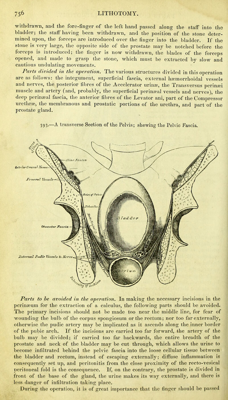 withdrawn, aud the fore-finger of the left hand passed along the staff into the bladder; the statf having been withdrawn, and the position of the stone deter- mined upon, the forceps are introduced over the fiuger into the bladder. If the stone is very large, the opposite side of the prostate may be notched before the forceps is introduced; the finger is now withdrawn, the blades of the forceps opened, and made to grasp the stone, which must be extracted by slow and cautious undulating movements. Parts divided in the operation. The various structures divided in this operation are as follows: the integument, superficial fascia, external hsemorrhoidal vessels and nerves, the posterior fibres of the Accelerator urins, the Transversus perinsi muscle and artery (and, probably, the superficial perinatal vessels and nerves), the deep perinseal fascia, the anterior fibres of the Levator ani, part of the Compressor uretla-ffi, the membranous and prostatic portions of the urethra, and part of the prostate gland. 393.—A transverse Section of the Pelvis; shewing the Pelvic Fascia. Parts to be avoided in the operation. In making the necessary incisions in the pcriniEum for the extraction of a calculus, the following parts should be avoided. The primary incisions should not be made too near the middle line, for fear of wounding the bulb of the corpus spongiosum or the rectum; nor too far externally, otherwise the pudic artery may be implicated as it ascends along the inner border of the pubic arcli. If the incisions are carried too far forward, the artery of the bulb may be divided; if carried too far backwards, the entire breadth of the prostate and neck of the bladder may be cut through, which allows the urine to become infiltrated behind the pelvic fascia into tlie loose cellular tissue between the bladder and rectum, instead of escaping externally; diffuse inflammation is, consequently set up, and peritonitis from the close proximity of the recto-vcsical peritoneal fold is the consequence. If, on the contrary, the prostate is divided in front of the base of the gland, the urine makes its way externally, and there is less danger of infiltration taking place. During the operation, it is of great importance that the finger should be passed