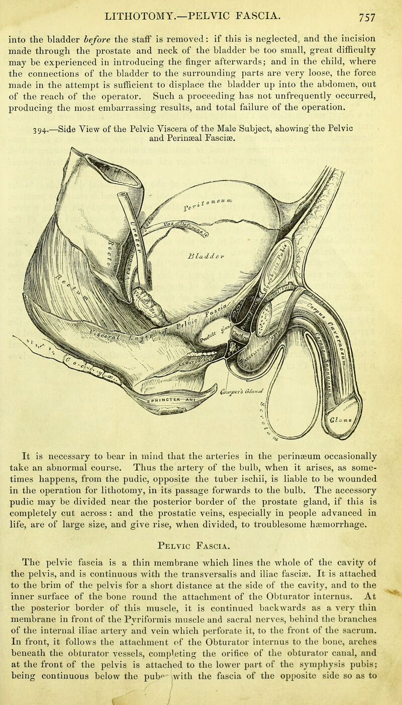 into the bladder before the staff is removed: if this is neglected, and the incision made through the prostate and neck of the bladder be too small, great difficulty- may be experienced in introducing the finger afterwards; and in the child, where the connections of the bladder to the surrounding parts are very loose, the force made in the attempt is sufficient to displace the bladder up into the abdomen, out of the reach of the operator. Such a proceeding has not unfrequently occurred, producing the most embarrassing results, and total failure of the operation. 394.—Side View of the Pelvic Viscera of the Male Subject, showing the Pelvic and Perineal Fasciae. It is necessary to bear in mind that the arteries in the perineeum occasionally take an abnormal course. Thus the artery of the bulb, when it arises, as some- times happens, from the pudic, opposite the tuber ischii, is liable to be wounded in the operation for lithotomy, in its passage forwards to the bulb. The accessory pudic may be divided near the posterior border of the prostate gland, if this is completely cut across : and the prostatic veins, especially in people advanced in life, are of large size, and give rise, when divided, to troublesome haemorrhage. Pelvic Fascia. The pelvic fascia is a thin membrane which lines the whole of the cavity of the pelvis, and is continuous with the transversalis and iliac fascia. It is attached to the brim of the pelvis for a short distance at the side of the cavity, and to the inner surface of the bone round the attachment of the Obturator internus. At the posterior border of this muscle, it is continued backwards as a very tliin membrane in front of the Pyriformis muscle and sacral nerves, behind the branches of the internal iliac artery and vein which perforate it, to tlie front of the sacrum. In front, it follows the attachment of the Obturator internus to the bone, arches beneath the obturator vessels, completing the orifice of the obturator canal, and at the front of the pelvis is attached to the lower part of the symphysis pubis; being continuous below the pubp iwith the fascia of the opposite side so as to
