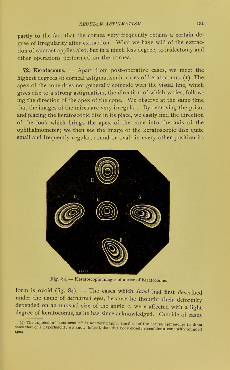 partly to the fact that the cornea very frequently retains a certain de- gree of irregularity after extraction. What we haye said of the extrac- tion of cataract applies also, but in a much less degree, to iridectomy and other operations performed on the cornea, 72. Keratoconus. — Apart from post-operative cases, we meet the highest degrees of corneal astigmatism in cases of keratoconus. (i) The apex of the cone does not generally coincide with the visual line, which gives rise to a strong astigmatism, the direction of which varies, follow- ing the direction of the apex of the cone. We observe at the same time that the images of the mires are very irregular. By removing the prism and placing the keratoscopic disc in its place, we easily find the direction of the look which brings the apex of the cone into the axis of the ophthalmometer; we then see the image of the keratoscopic disc quite small and frequently regular, round or oval; in every other position its Fig. 84. — Keratoscopic images of a case of keratoconus. form is ovoid (fig. 84). — The cases which Javal had first described under the name of decentered eyes, because he thought their deformity depended on an unusual size of the angle a, were affected with a light degree of keratoconus, as he has since acknowledged. Outside of cases (1) The expression keratoconus Is not very happy; the form of the cornea approaches In thes« cases that of a hyperboloid; we know, indeed, that this body closely resembles a cone with rounded apex.