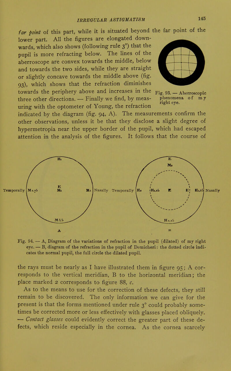 far point of this part, while it is situated beyond the far point of the lower part. All the figures are elongated down- wards, which also shows (following rule 3°) that the pupil is more refracting below. The lines of the aberroscope are convex towards the middle, below and towards the two sides, while they are straight or slightly concave towards the middle above (fig. 93), which shows that the refraction diminishes towards the periphery above and increases in the 93 _ Aberroscopic three other directions. — Finally we find, by meas- phenomena of my right eye. uring with the optometer of Young, the refraction indicated by the diagram (fig. 94, A). The measurements confirm the other observations, unless it be that they disclose a slight degree of hypermetropia near the upper border of the pupil, which had escaped attention in the analysis of the figures. It follows that the course of A Fig. 94. — A, Diagram of the variations of refraction in the pupil (dilated) of my right eye. — B, diagram of the refraction in the pupil of Demicheri: the dotted circle indi- cates the normal pupil, the full circle the dilated pupil. the rays must be nearly as I have illustrated them in figure 95; A cor- responds to the vertical meridian, B to the horizontal meridian; the place marked 2 corresponds to figure 88, c. As to the means to use for the correction of these defects, they still remain to be discovered. The only information we can give for the present is that the forms mentioned under rule 3° could probably some- times be corrected more or less effectively with glasses placed obliquely. — Contact glasses could evidently correct the greater part of these de- fects, which reside especially in the cornea. As the cornea scarcely