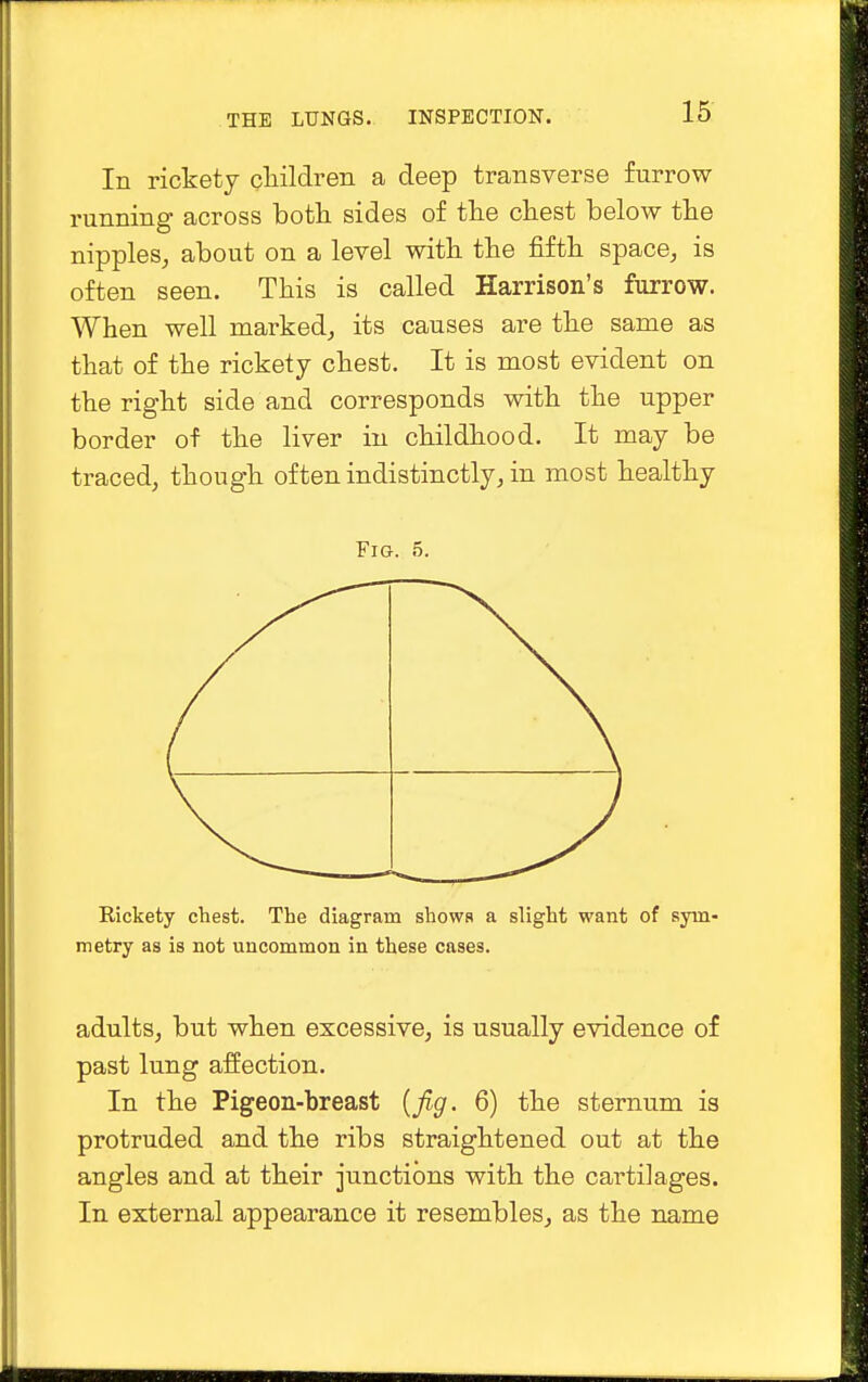 In rickety children a deep transverse furrow running across both sides of the chest below the nipples, about on a level with the fifth space, is often seen. This is called Harrison's furrow. When well marked, its causes are the same as that of the rickety chest. It is most evident on the right side and corresponds with the upper border of the liver in childhood. It may be traced, though often indistinctly, in most healthy Fig. 5. Rickety chest. The diagram showH a slight want of sym- metry as is not uncommon in these cases. adults, but when excessive, is usually evidence of past lung affection. In the Pigeon-breast {fig. 6) the sternum is protruded and the ribs straightened out at the angles and at their junctions with the cai'tilages. In external appearance it resembles, as the name