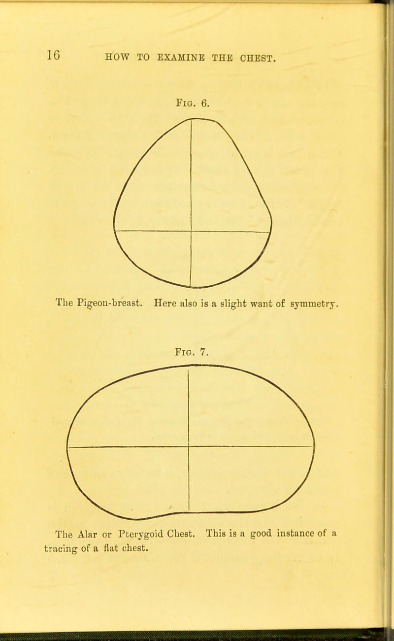 Fig. 6. The Pigeon-breast. Here also is a slight want of symmetry. Fig, 7. The Alar or Pterygoid Chest. This is a good instance of a tracing of a flat chest.