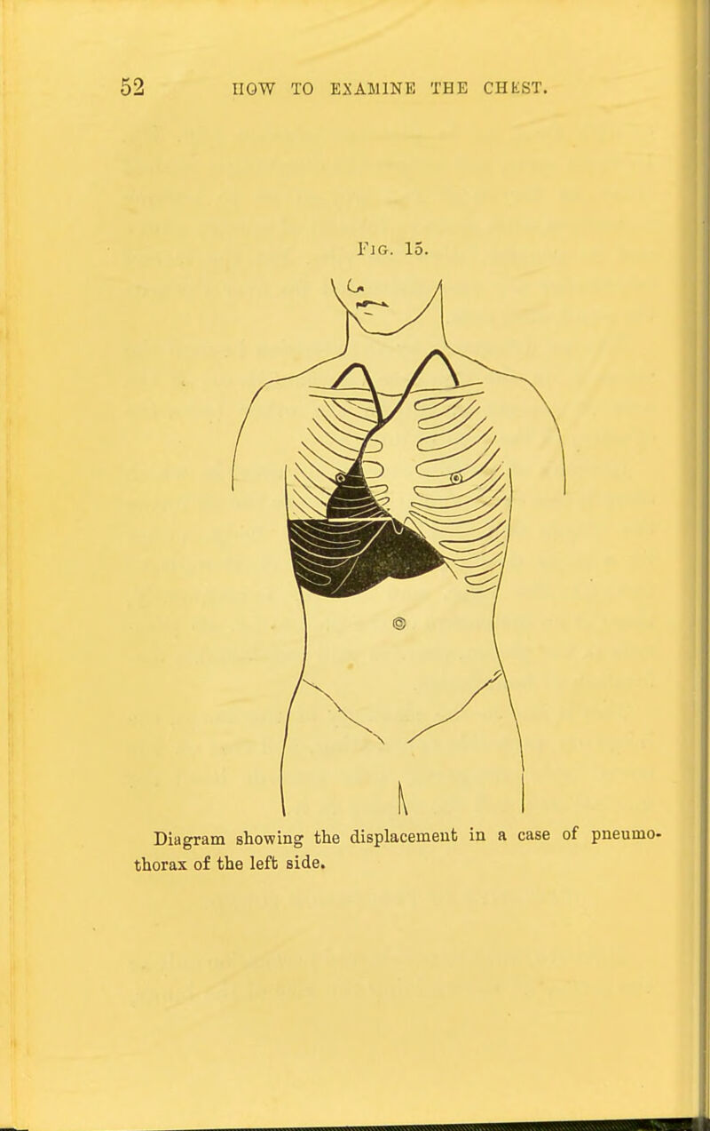 1 i Diagram showing the displacement in a case of pneumo. thorax of the left side.