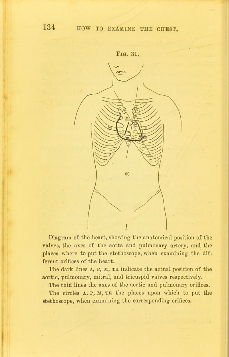 Fig. 31. Diagram of the heart, showing the anatomical position of the valves, the axes of the aorta and pulmonary artery, and the places where to put the stethoscope, when examining the dif- ferent orifices of the heart. The dark lines A, P, M, tb indicate the actual position of the aortic, pulmonary, mitral, and tricuspid valves respectively. The thin lines the axes of the aortic and pulmonary orifices. The circles A., P, M, tb the places upon which to put the stethoscope, when examining the corresponding orifices.