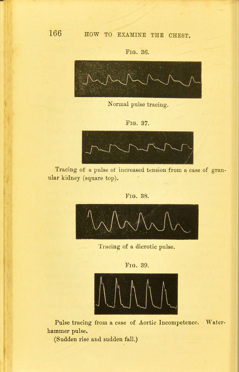 Fig. 36. Normal pulse tracing. Fig. 37. Tracing of a pulse of increased tension from a case of gran ular kidney (square top). Fig. 38. Tracing of a dicrotic pulse. Fig. 39. Pulse tracing from a case of Aortic Incompetence. Water- hammer pulse. (Sudden rise and sudden fall.)