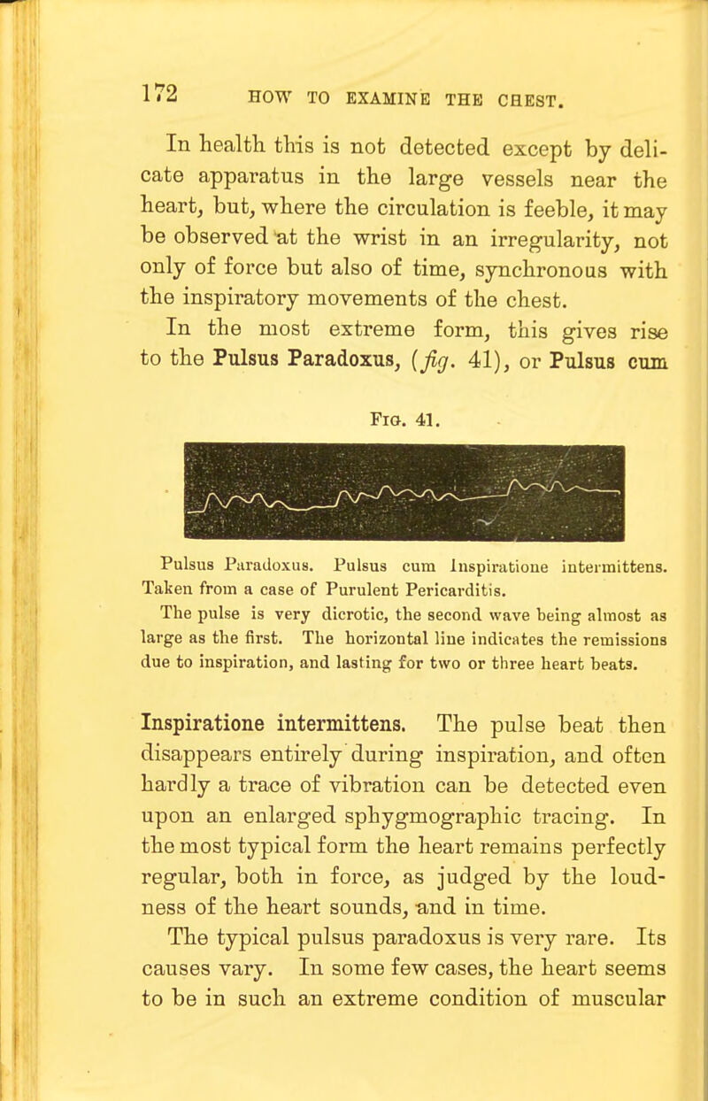 In health this is not detected except by deli- cate apparatus in the large vessels near the heart, but, where the circulation is feeble, it may be observed at the wrist in an irregularity, not only of force but also of time, synchronous with the inspiratory movements of the chest. In the most extreme form, this gives rise to the Pulsus Paradoxus, {fig. 41), or Pulsus cum Fio. 41. Pulsus Paradoxus. Pulsus cum Inspiratione intermittens. Taken from a case of Purulent Pericarditis. The pulse is very dicrotic, the second wave being almost as large as the first. The horizontal line indicates the remissions due to inspiration, and lasting for two or three heart heats. Inspiratione intermittens. The pulse beat then disappears entirely during inspiration, and often hardly a trace of vibration can be detected even upon an enlarged sphygmographic tracing. In the most typical form the heart remains perfectly regular, both in force, as judged by the loud- ness of the heart sounds, -and in time. The typical pulsus paradoxus is very rare. Its causes vary. In some few cases, the heart seems to be in such an extreme condition of muscular