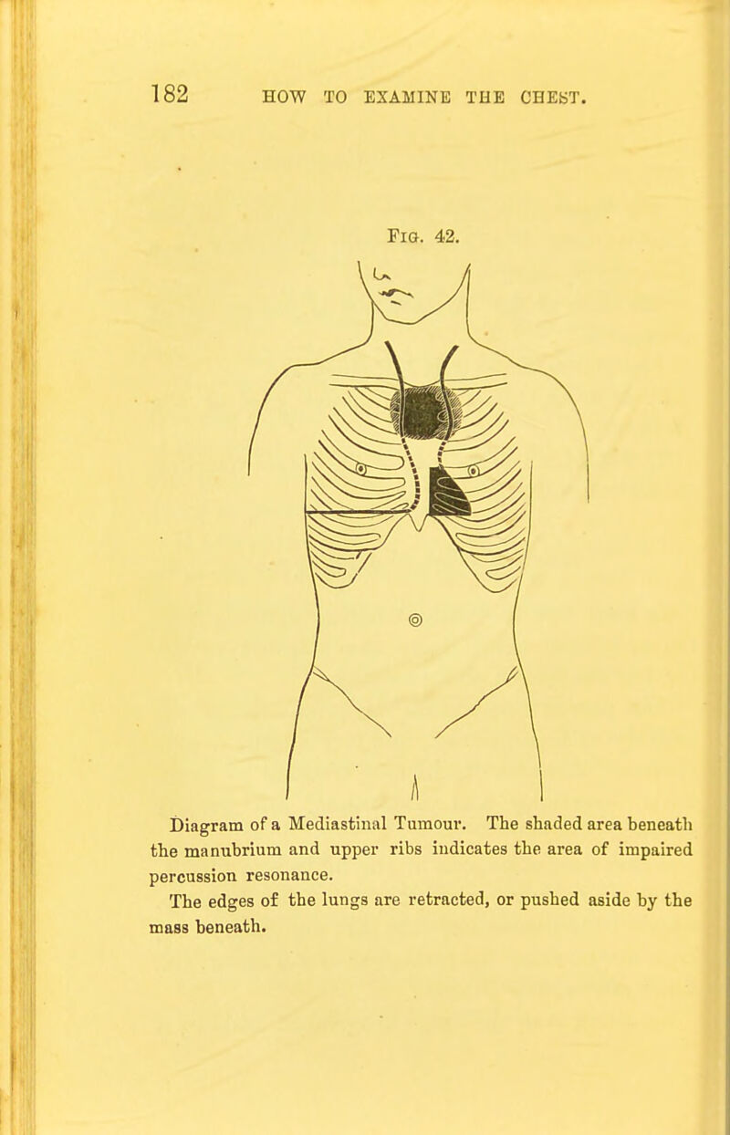 Fig. 42. Diagram of a Mediastinal Tumour. The shaded area beneath the manubrium and upper ribs indicates the area of impaired percussion resonance. The edges of the lungs are retracted, or pushed aside by the mass beneath.