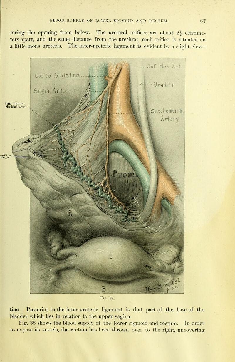 BLOOD SUPPLY OF LOWER SIGMOID AND RECTUM. 6T tering tlie opening from below. The ureteral orifices are about 2^ centime- ters apart, and the same distance from the urethra; each orifice is situated on a little mons ureteris. The inter-ureteric ligament is evident by a slight eleva- FiG. 38. tion. Posterior to the inter-ureteric ligament is that part of the base of the bladder which lies in relation to the upper vagina. Fig. 38 shows the blood supply of the lower sigmoid and rectum. In order