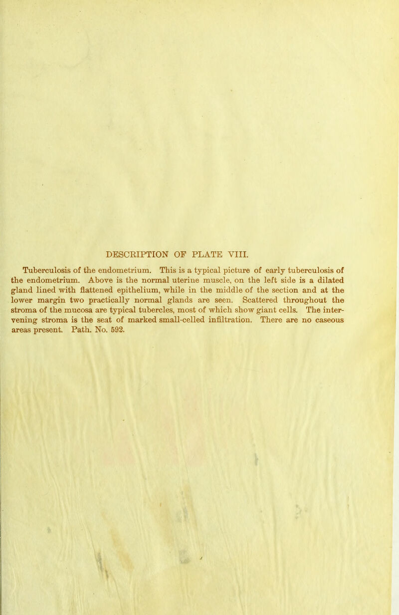 Tuberculosis of the endometrium. This is a typical picture of early tuberculosis of the endometrium. Above is the normal uterine muscle, on the left side is a dilated gland lined with flattened epithelium, while in the middle of the section and at the lower margin two practically normal glands are seen. Scattered throughout the stroma of the mucosa are typical tubercles, most of which show giant cells. The inter- vening stroma is the seat of marked small-celled infiltration. There are no caseous areas present. Path. No. 592.