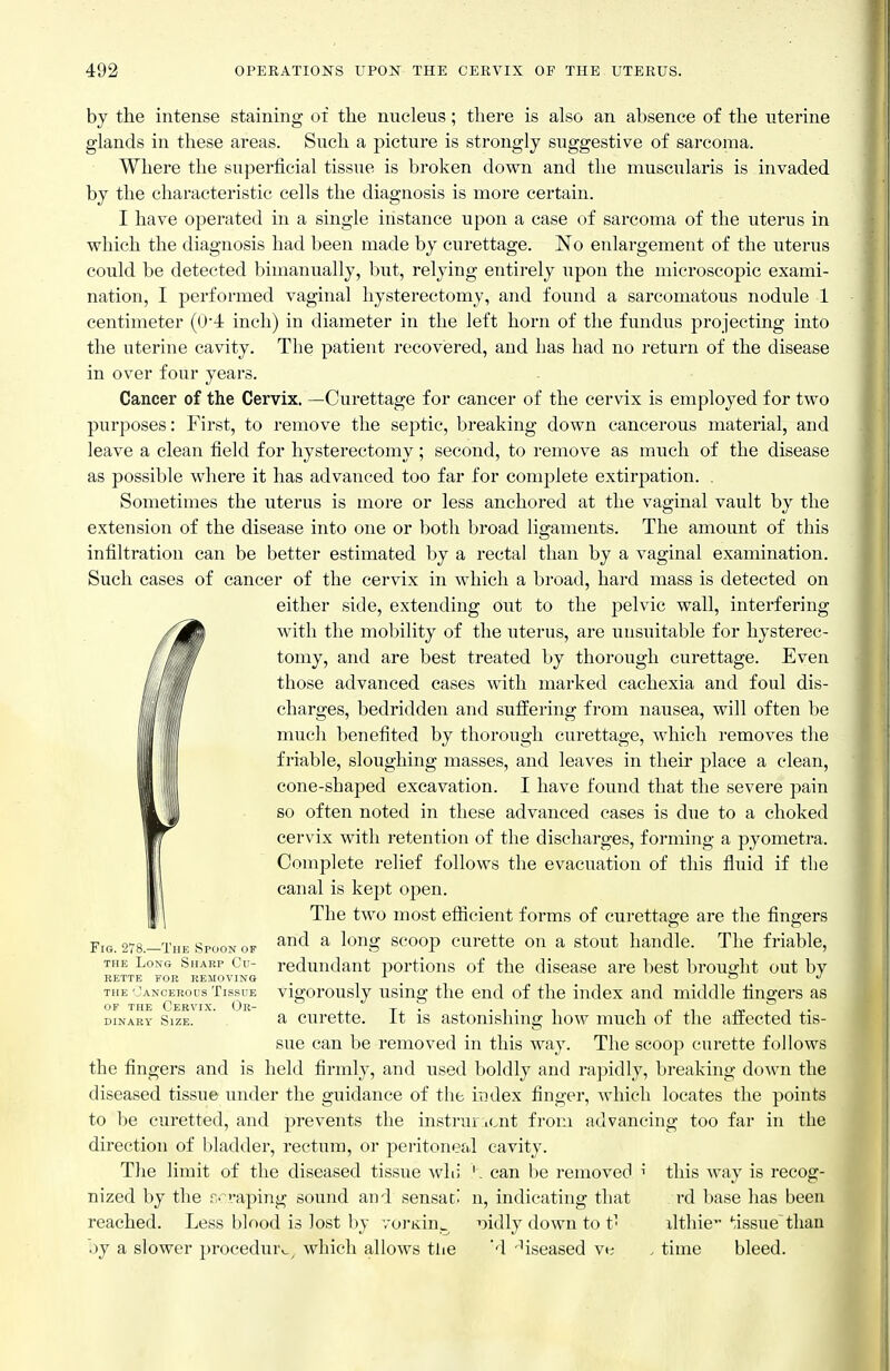 by the intense staining of the nucleus; there is also an absence of the uterine glands in these areas. Such a picture is strongly suggestive of sarcoma. Where the snperficial tissue is broken down and the muscularis is invaded by the characteristic cells the diagnosis is more certain. I have operated in a single instance upon a case of sarcoma of the uterus in which the diagnosis had been made by curettage. No enlargement of the uterus could be detected bimanually, but, relying entirely upon the microscopic exami- nation, I performed vaginal hysterectomy, and found a sarcomatous nodule 1 centimeter (04 inch) in diameter in the left horn of the fundus projecting into the uterine cavity. The patient recovered, and has had no return of the disease in over four years. Cancer of the Cervix. —Curettage for cancer of the cervix is employed for two purposes: First, to remove the septic, breaking down cancerous material, and leave a clean field for hysterectomy; second, to remove as much of the disease as possible where it has advanced too far for complete extirpation. . Sometimes the uterus is more or less anchored at the vaginal vault by the extension of the disease into one or l)oth broad ligaments. The amount of this infiltration can be better estimated by a rectal than by a vaginal examination. Such cases of cancer of the cervix in which a broad, hard mass is detected on either side, extending out to the pelvic wall, interfering with the mobility of the uterus, are unsuitable for hysterec- tomy, and are best treated by thorough curettage. Even those advanced cases with marked cachexia and foul dis- charges, bedridden and suffering from nausea, will often be much benefited by thorough curettage, which removes the friable, sloughing masses, and leaves in their place a clean, cone-shaped excavation. I have found that the severe pain so often noted in these advanced cases is due to a choked cervix with retention of the discharges, forming a pyometra. Complete relief follows the evacuation of this fluid if the canal is kept open. The two most efficient forms of curettage are the fingers and a long scoop curette on a stout handle. The friable, redundant portions of the disease are best brought out by vigorously using the end of the index and middle fingers as a curette. It is astonishing how much of the affected tis- sue can be removed in this way. The scoop curette follows the fingers and is held firmly, and used boldly and rapidly, breaking down the diseased tissue under the guidance of the index finger, which locates the points to be curetted, and prevents the instrur icnt from advancing too far in the direction of bladder, rectum, or peritoneal cavity. The limit of the diseased tissue whi ' . can l)e removed nized by the raping sound and sensaci n, indicating that reached. Less blood is lost by voi'Kin^ ^jidly down to t' oy a slower procedure, which allows tlie 'I Mseased ve Fig. 278.—The Spoon of THE Long Sharp Cu- rette for removing THE OaNCEROUS TiSSUE of the Cervix. Oii- DINARY Size. this way is recog- rd base has been ilthie- '■issue'thau time bleed.