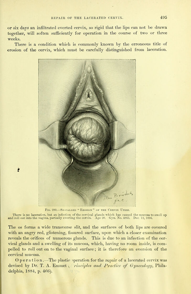 or six days an infiltrated everted cervix, so rigid that tlie lips can not be drawn together, will soften sufficiently for operation in the course of two or three weeks. There is a condition which is commonly known by the erroneous title of erosion of the cervix, which must be carefully distinguished from laceration. J Fig. 280.—So-called  Erosion  of the Cervix Uteri. There is no laceration, but an infection of the cervical glands which has caused the mucosa to swell up and roll out into the vagina, partially everting the cervix. Age 20. Gyn. No. 4865. Dee. 12, 1896. The OS forms a wide transverse slit, and the surfaces of both li])s are covered with an angry red, glistening, fissured surface, upon which a closer examination reveals the orifices of numerous glands. This is due to an infection of the cer- vical glands and a swelling of its mucosa, which, having no room inside, is com- pelled to roll out on to the vaginal surface; it is therefore an eversion of the cervical mucosa. Operation.—The plastic tperation for the repair of a lacerated cervix was devised by Dr. T. A. Emmet ^ rinciples and Practice of Gynecology, Phila- delphia, 1881, p. 466).