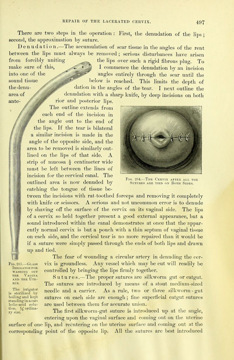 First, the denudation of the lips ; There are two steps in the operation second, the approximation by suture. Denudation.—The accumulation of scar tissue in the angles of the rent between the lips must always be removed; serious disturbances have arisen from forcibly uniting ^^^-^ ^ips over such a rigid fibrous plug. To make sure of this, into one of the sound tissue the dciiu- area ol ante- I commence the denudation by an incision , , angles entirely through the scar until the below is reached. This limits the depth of dation in the angles of the tear. I next outline the denudation with a sharp knife, by deep incisions on both rior and posterior lips. The outline extends from each end of the incision in 'f the angle out to the end of the lips. If the tear is bilateral a similar incision is made in the 3gle of the opposite side, and the 3a to be removed is similarly out- ed on the lips of that side. A ip of mucosa ^ centimeter wide ist 1)0 left between the lines of vision for the cervical canal. The tlined area is now denuded by Fib. a84.—The Cervix after all the Sutures are tied on Both Sides. I telling the tongue of tissue be- reen the incisions with rat-toothed forceps and removing it completely itli knife or scissors. A serious and not uncommon error is to denude / shaving off the surface of the cervix on its vaginal side. The lips of a cervix so held together present a good external appearance, but a sound introduced within the canal demonstrates at once that the appar- ently normal cervix is but a pouch with a thin septum of vaginal tissue on each side, and the cervical tear is no more repaired than it woiild be if a suture were simply passed through the ends of both lips and drawn up and tied. The fear of wounding a circular artery in denuding the cer- vix is groundless. Any vessel which may be cut will readily be controlled by bringing the lips firmly together. Sutures.—The proper sutures are silkworm gut or catgut. The sutures are introduced by means of a stout medium-sized needle and a carrier. As a rule, two or three silkworm - gut sutures on each side are enough; fine superficial catgut sutures are used between them for accurate union. The first silkworm-gut suture is introduced up at the angle, entering upon the vaginal surface and coming out on the uterine surface of one lip, and reentering on the uterine surface and coming out at the corresponding point of the opposite lip. All the sutures are best introduced II Fio. 2S5.—Glass Irrigator for WASHING out the Vagina AND the Ute- rus. The irrigator is sterilized by boiling and kept standing in a car- bolic-acid solu- tion, ordina- ry size.