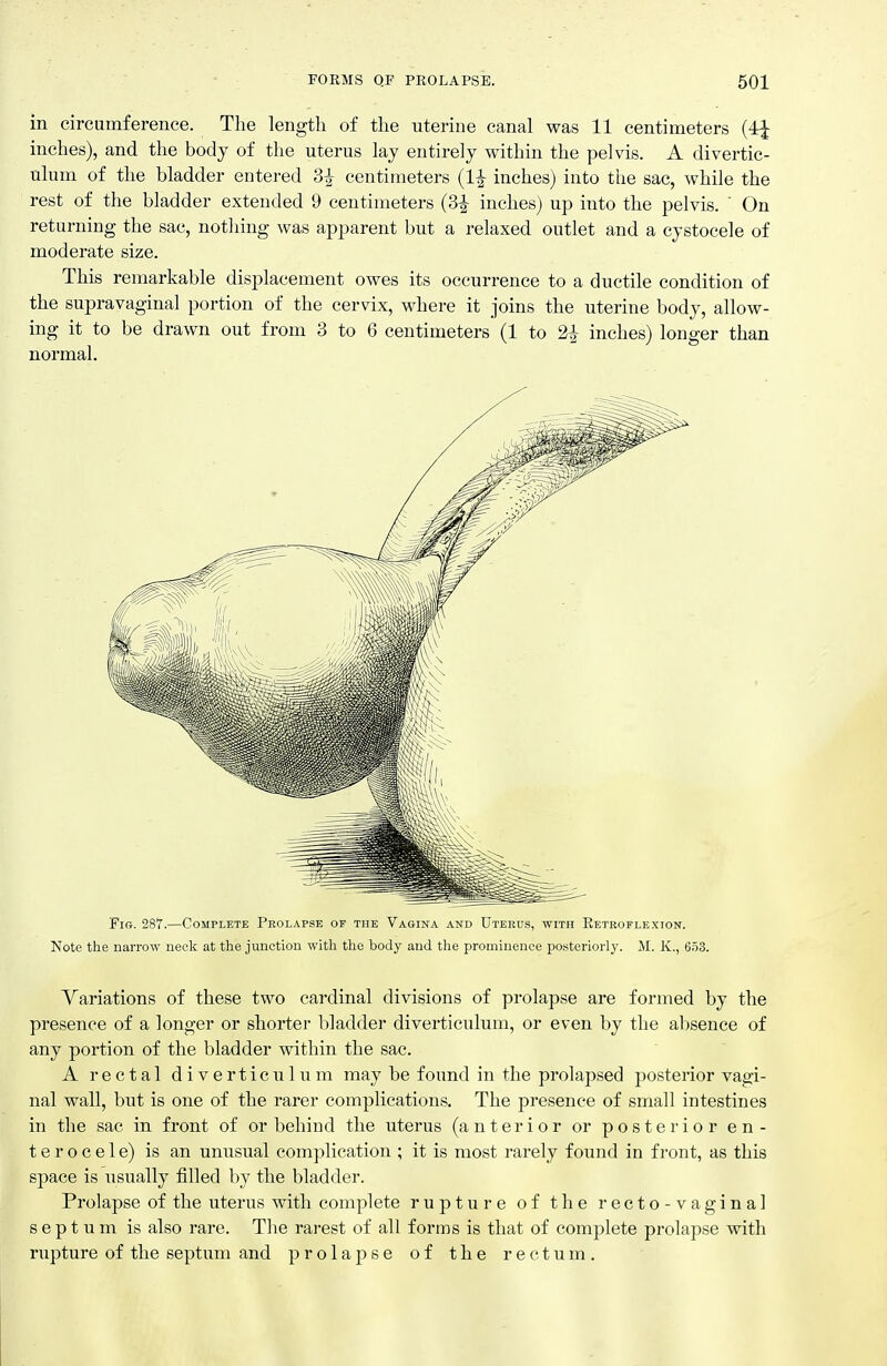 in circumference. The length of the uterine canal was 11 centimeters (4^ inches), and the body of the uterus lay entirely within the pelvis. A divertic- ulum of the bladder entered 3^ centimeters (1^ inches) into the sac, while the rest of the bladder extended 9 centimeters (3^ inches) up into the pelvis. ' On returning the sac, nothing was apparent but a relaxed outlet and a cystocele of moderate size. This remarkable displacement owes its occurrence to a ductile condition of the supravaginal portion of the cervix, where it joins the uterine body, allow- ing it to be drawn out from 3 to 6 centimeters (1 to 2^ inches) longer than normal. Fir. 287.—Complete Pkolapse of the Vagina and Uterus, with Eetroflexion. Note the narrow neck at the junction with the body and the prominence po.stcriorly. M. K., 6o3. Variations of these two cardinal divisions of prolapse are formed by the presence of a longer or shorter bladder diverticulum, or even by the absence of any portion of the bladder within the sac. A rectal diverticulum may be found in the prolapsed posterior vagi- nal wall, but is one of the rarer complications. The presence of small intestines in the sac in front of or behind the uterus (anterior or posterior en- ter o c e 1 e) is an unusual complication ; it is most rarely found in front, as this space is usually filled by the bladder. Prolapse of the uterus with complete rupture of the recto-vaginal septum is also rare. The rarest of all forms is that of complete prolapse with rupture of the septum and prolapse of the rectum.