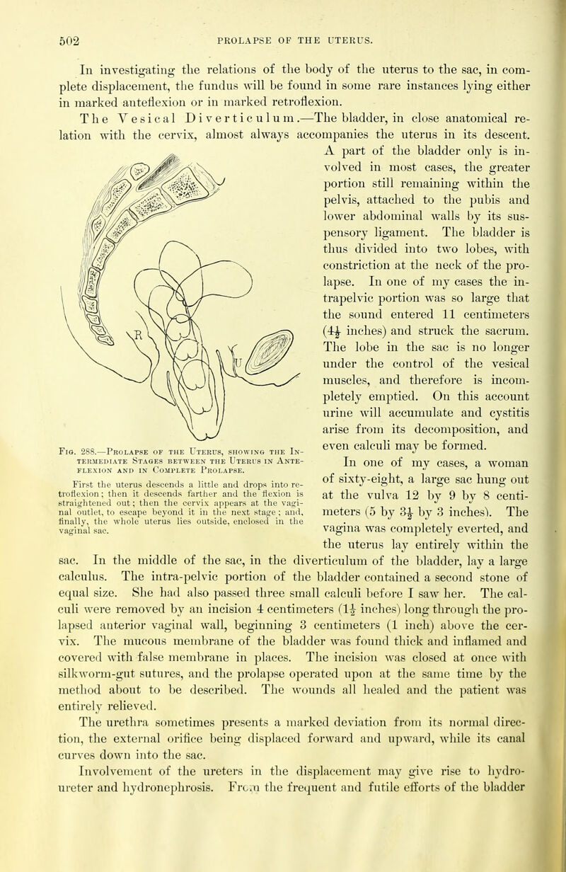 In investigating tlie relations of the body of the uterus to the sac, in com- plete displacement, the fundus will be found in some rare instances lying either in marked anteflexion or in marked retroflexion. The Vesical Diverticulum.—The bladder, in close anatomical re- lation with the cervix, almost always accompanies the uterus in its descent. A part of the bladder only is in- volved in most cases, the greater portion still remaining within the pelvis, attached to the pubis and lower abdominal walls by its sus- pensory ligament. The bladder is thus divided into two lobes, with constriction at the neck of the pro- lapse. In one of my cases the in- trapelvic portion was so large that the sound entered 11 centimeters (4:^ inches) and struck the sacrum. The lobe in the sac is no longer under the control of the vesical muscles, and therefore is incom- pletely emptied. On this account urine will accumulate and cystitis arise from its decomposition, and even calculi may be formed. In one of my cases, a woman of sixty-eight, a large sac hung out at the vulva 12 by 9 by 8 centi- meters (5 by 3^ by 3 inches'). The vagina was completely everted, and the uterus lay entirely within the sac. In the middle of the sac, in the diverticulum of the bladder, lay a large calculus. The intra-pelvic portion of the bladder contained a second stone of equal size. She had also passed three small calculi before I saw her. The cal- culi were removed by an incision 4 centimeters (1^ inches) long through the pro- lapsed anterior vaginal wall, beginning 3 centimeters (1 inch) above the cer- vix. The mucous membrane of the bladder was found thick and inflamed and covered with false membrane in places. The incision was closed at once with silkworm-gut sutures, and the prolapse operated upon at the same time by the method about to be described. The wounds all healed and the patient was entirely relieved. The urethra sometimes presents a marked deviation from its normal direc- tion, the external orifice being displaced forward and upward, while its canal curves down into the sac. Involvement of the ureters in the displacement may give rise to hydro- ureter and hydronephrosis. Frc.n the frequent and futile efforts of the bladder Fio. 288.—Prolapse of the Uterus, showing the In- termediate Stages between the Uterus in Ante- flexion AND IN Complete Prolapse. First the uterus descends a little and drops into re- troflexion ; then it descends fartlier and the fle.xion is straightened out; then the cervix appears at the vagi- nal outlet, to escape beyond it in the next stage ; and, finally, the whole uterus lies outside, enclosed in the vaffinal sac.