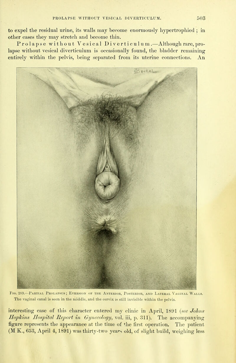 to expel the residual urine, its walls may become enormously hypertropliied ; in other cases they may stretch and become thin. Prolapse without Vesical Diverticulum .—Although rare, pro- lapse without vesical diverticulum is occasionally found, the bladder remaining^ entirely within the pelvis, being separated from its uterine connections. An \ Fig. 2S'J.- rAUTLAi, I'ikji-ai'm s ; Eveicsm.n uf the Anterior, I'ostkriuh, anh ]>atekal \'a..i.\al W alls. The vaginal canal is seen in the middle, and the cervix is still invisible within the pelvis. interesting case of this character entered my clinic in April, 1891 {see Johns HopTcins Hospital Report in Gynecologxj^ vol. iii, p. 311). The accompanying figure represents the appearance at the time of the first operation. The patient (M K., 653, April 4,1891) was thirty-two yeavvj old, of slight build, weighing less