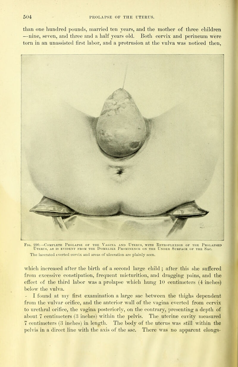 than one hundred pounds, married ten years, and the mother of three children —nine, seven, and three and a half years old. Both cervix and perineum were torn in an unassisted first labor, and a protrusion at the vulva was noticed then. Fig. 290.—Complete Prolapse of the Vagina and Uterus, with Eetrofle.xion of the Prolapsed Uterus, as is evident from the Domelike Prominence on the Under Surface of the Sac. The lacerated everted cervix and areas of ulceration are plainly seen. which increased aftei the birth of a second large child ; after this she suffered from excessive constipation, frequent micturition, and dragging pains, and the effect of the third labor was a prolapse which hung 10 centimeters (4 inches) below the vulva. - I found at my first examination a large sac between the thighs dependent from the vulvar orifice, and the anterior wall of the vagina everted from cervix to urethral orifice, the vagina postei-iorly, on the conti'ary, presenting a depth of about 7 centimeters (3 inches) within the pelvis. The uterine cavity measui-ed 7 centimeters (3 inches) in length. The body of the uterus was still within the pelvis in a direct line with the axis of the sac. There was no apparent elonga-